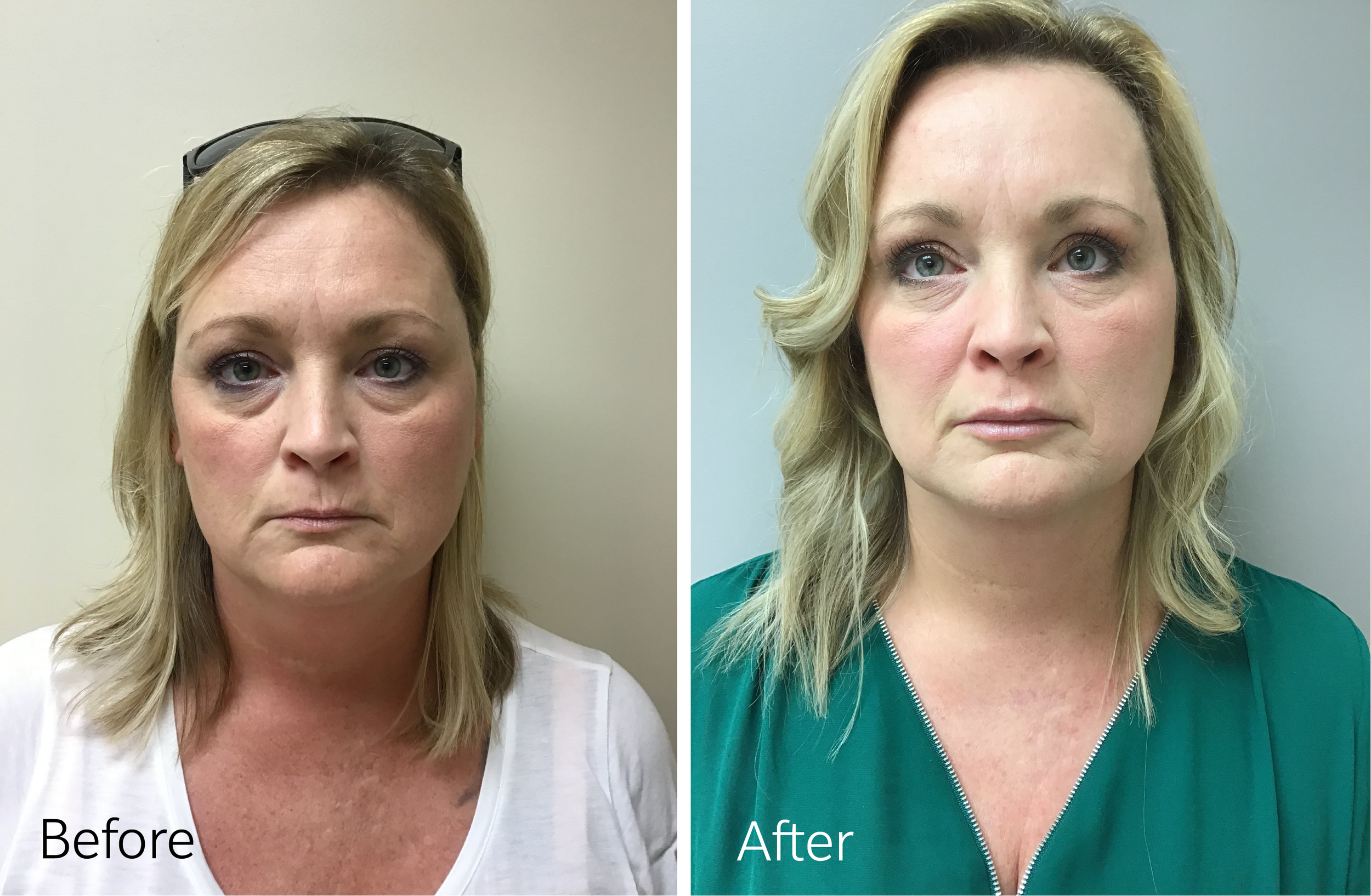 Eyelid surgery by Dr. Steven Porto, Board Certified Plastic Surgeon in Indianapolis, Indiana