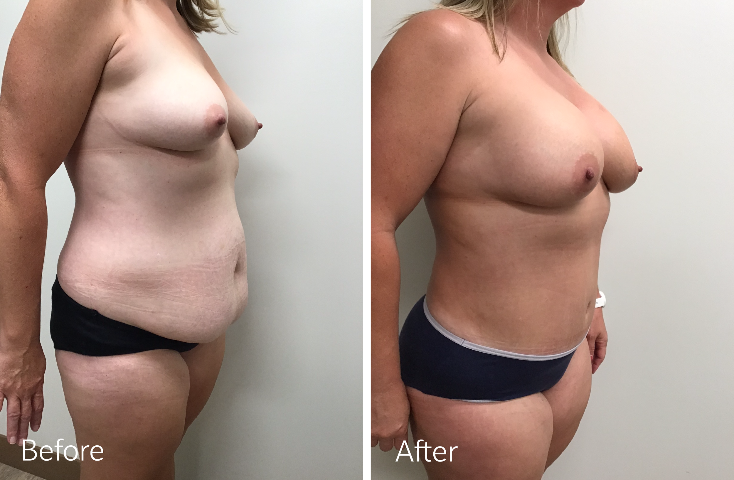 Tummy tuck, breast lift and implant surgery by Dr. Steven Porto, Board Certified Plastic Surgeon in Indianapolis, Indiana