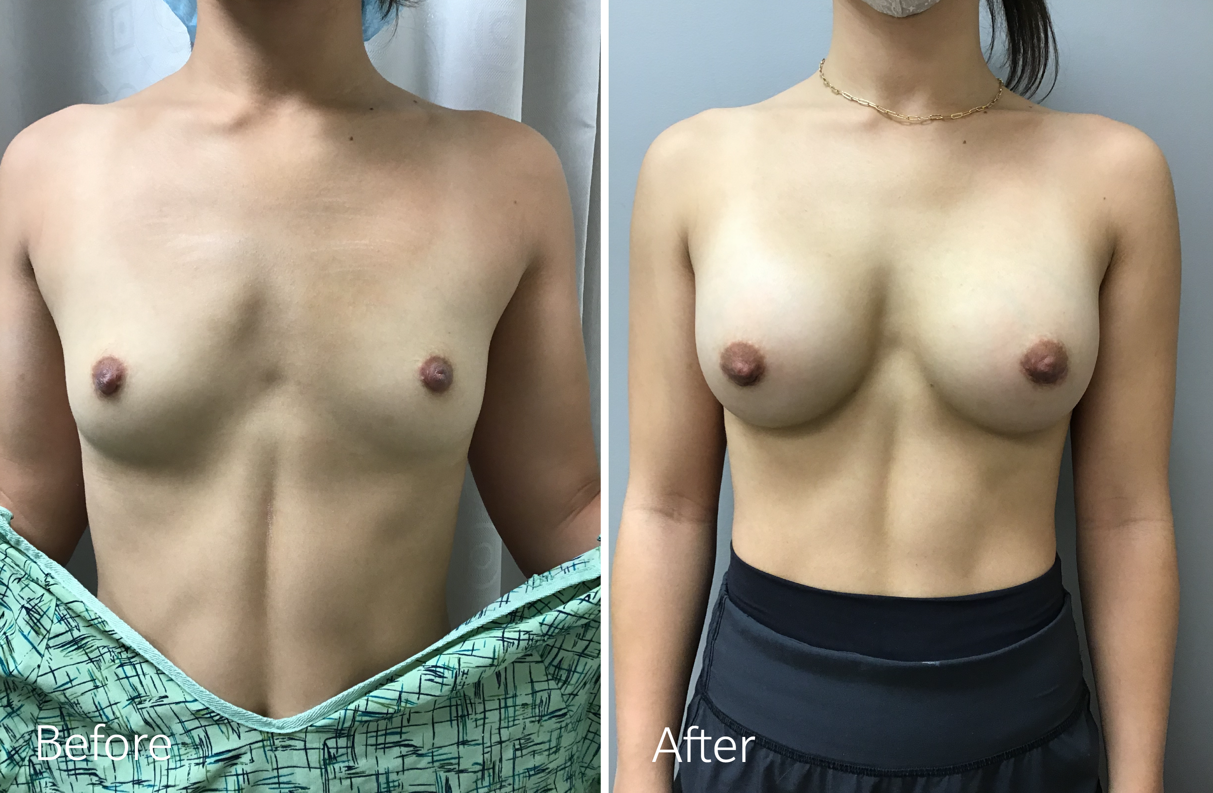 Breast Augmentation Surgery with 240cc Implants by Dr. Steven Porto