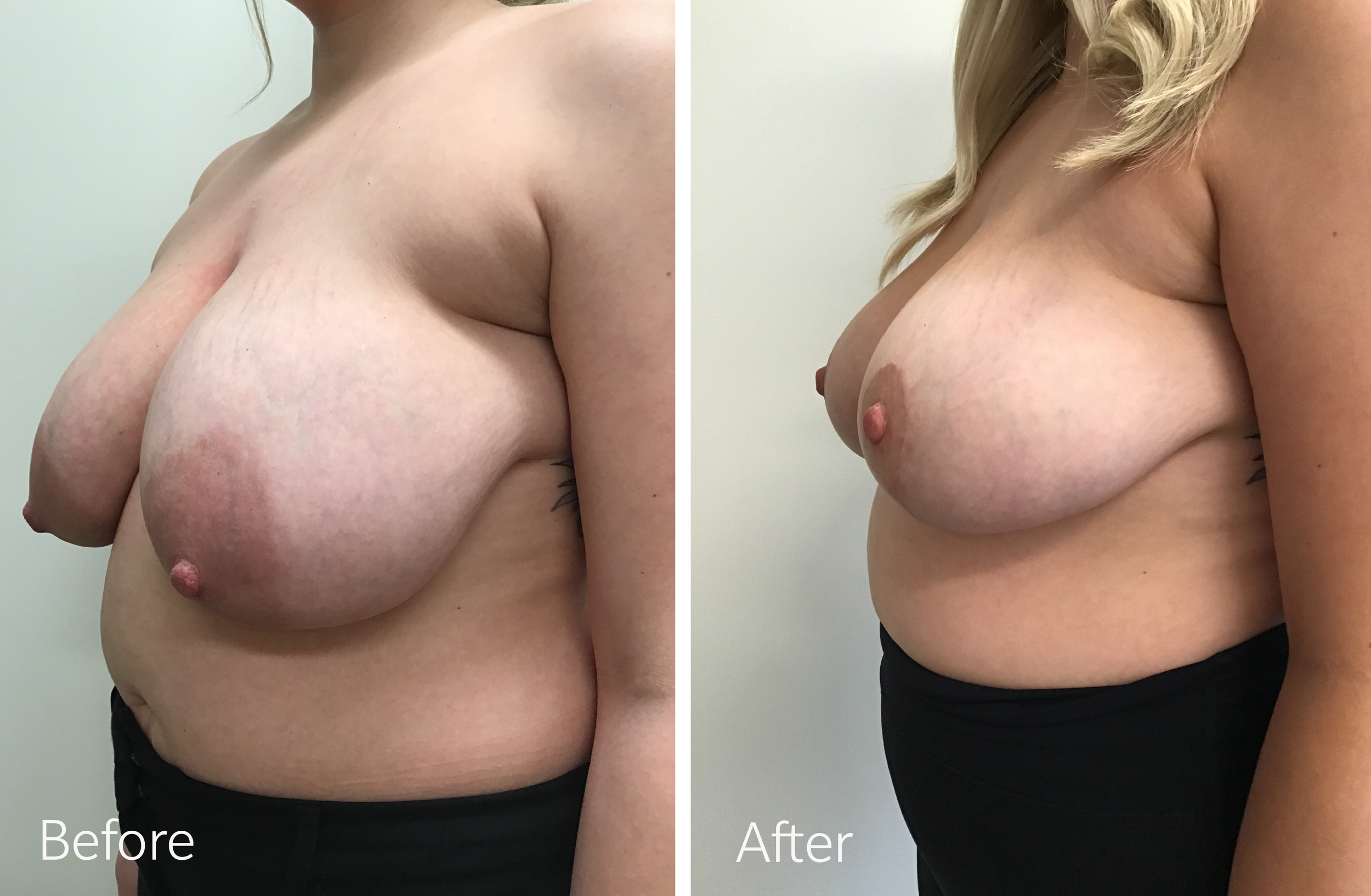 Breast reduction surgery by Dr. Steven Porto