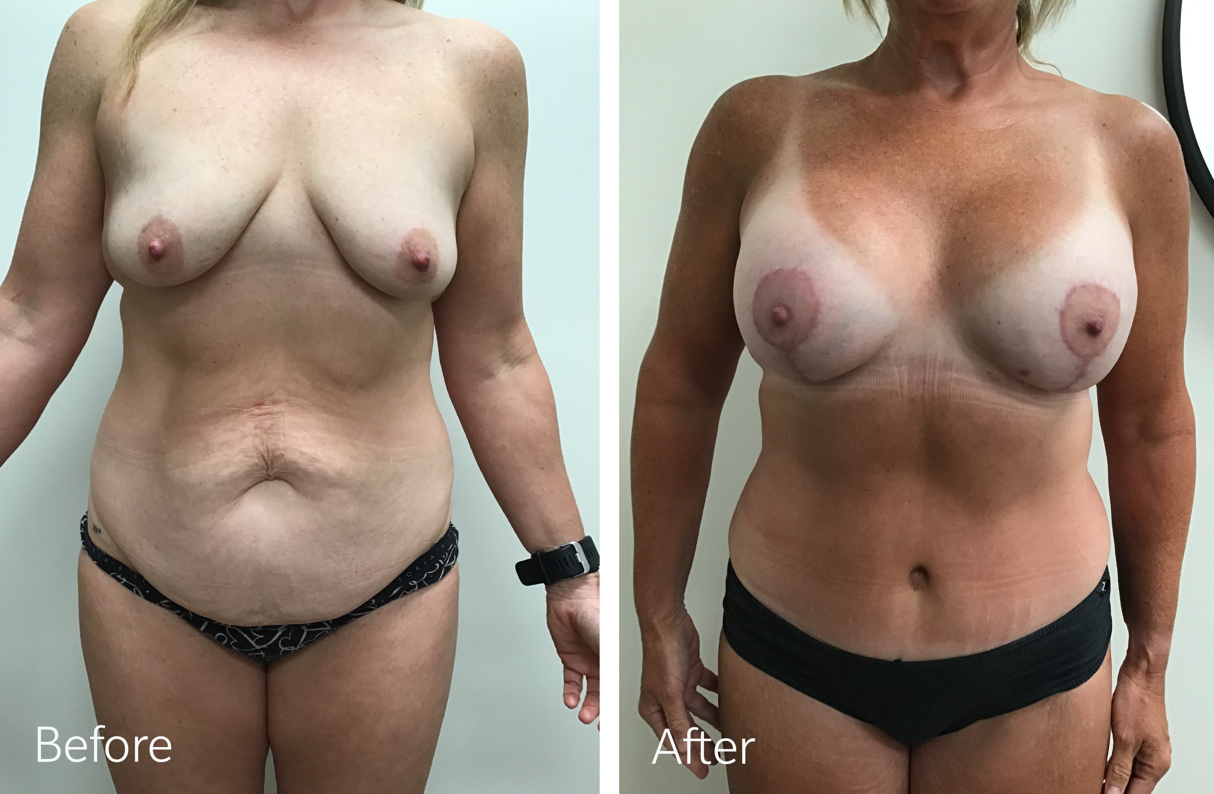 Tummy tuck, breast lift and implant surgery by Dr. Steven Porto, Board Certified Plastic Surgeon in Indianapolis, Indiana