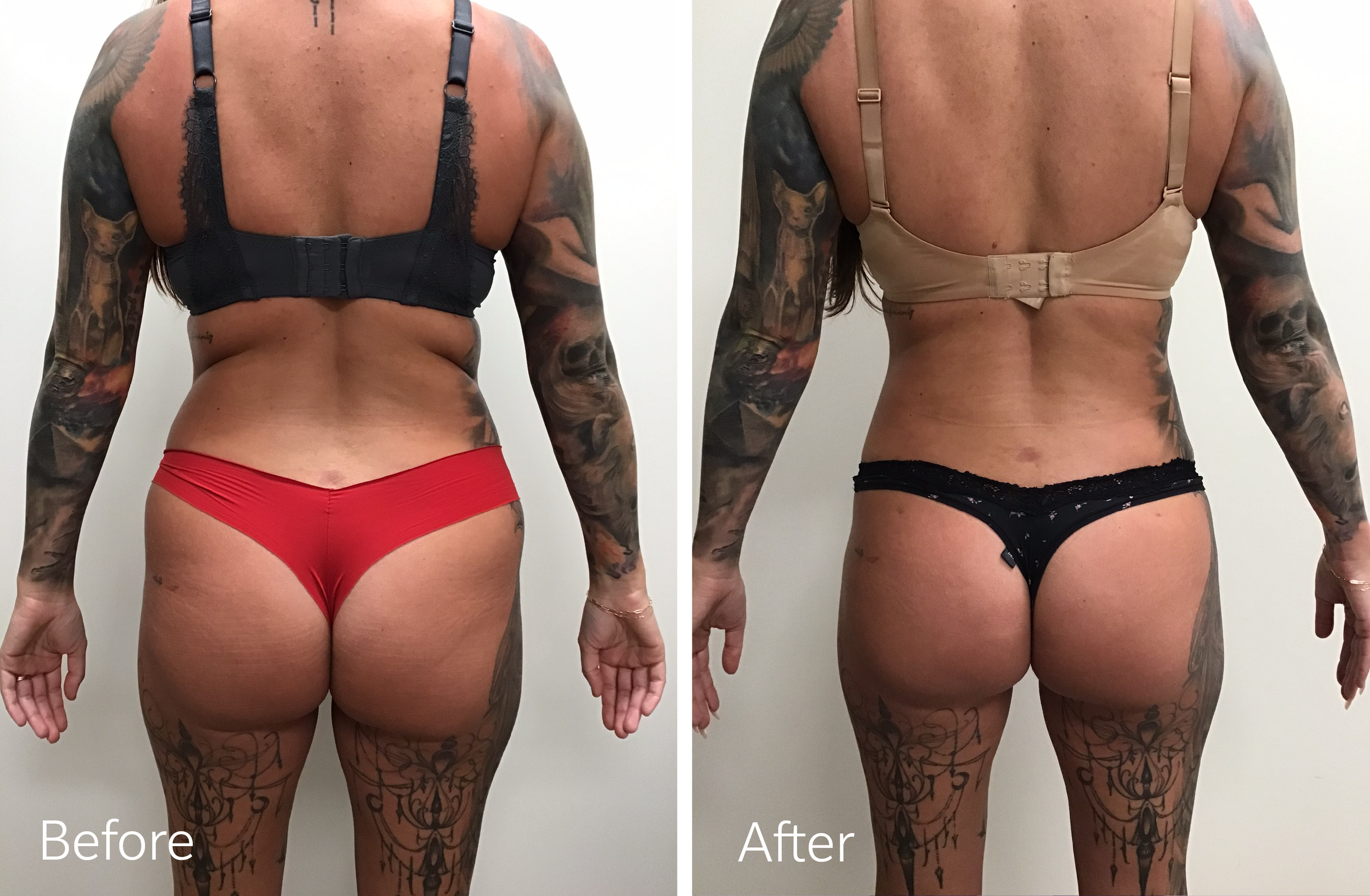 Vaser liposuction plastic surgery by Dr. Steven Porto, Board Certified Plastic Surgeon in Indianapolis, Indiana