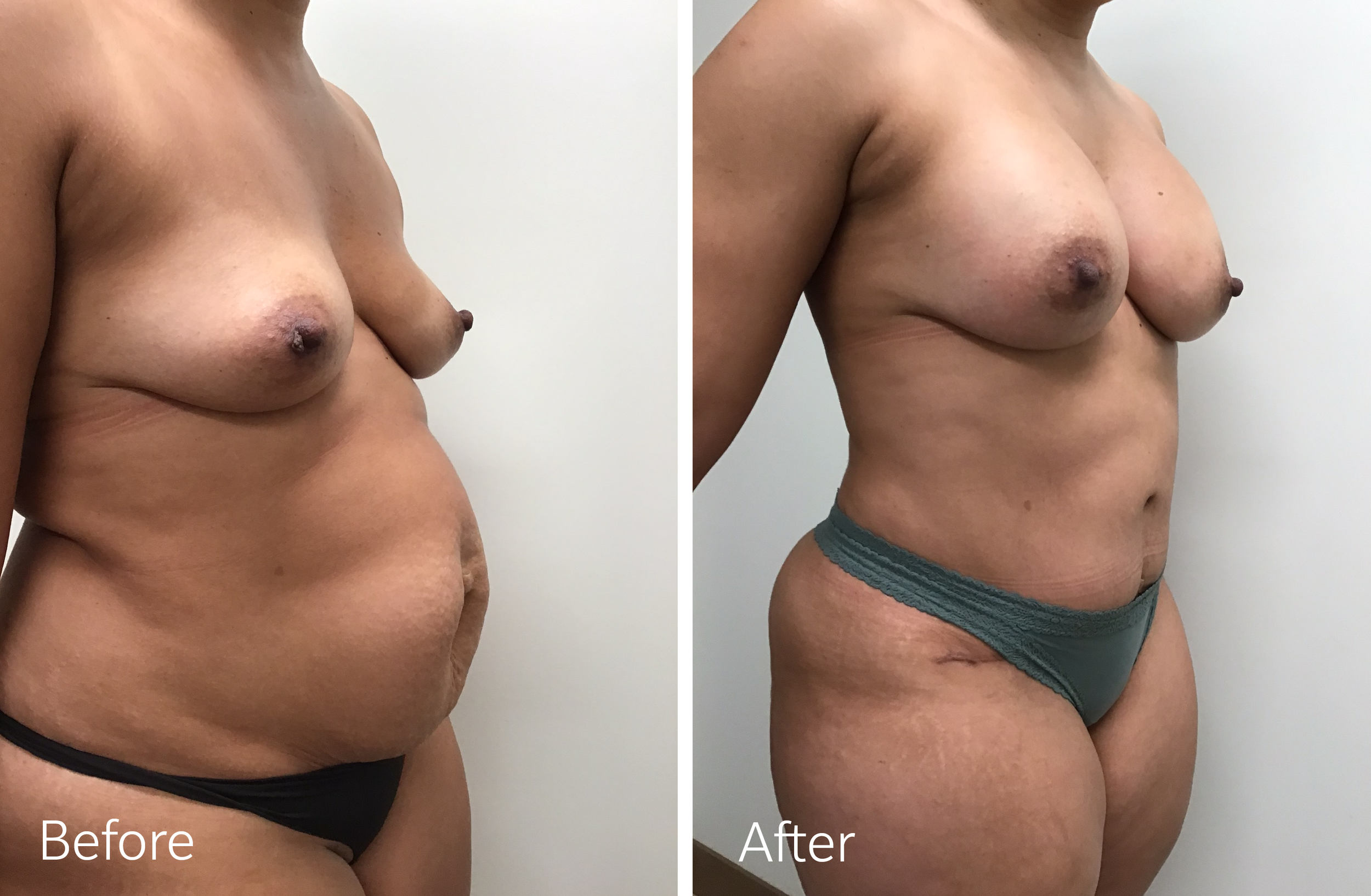 Tummy tuck, breast lift and implant surgery by Dr. Steven Porto, Board Certified Plastic Surgeon in Indianapolis, Indiana