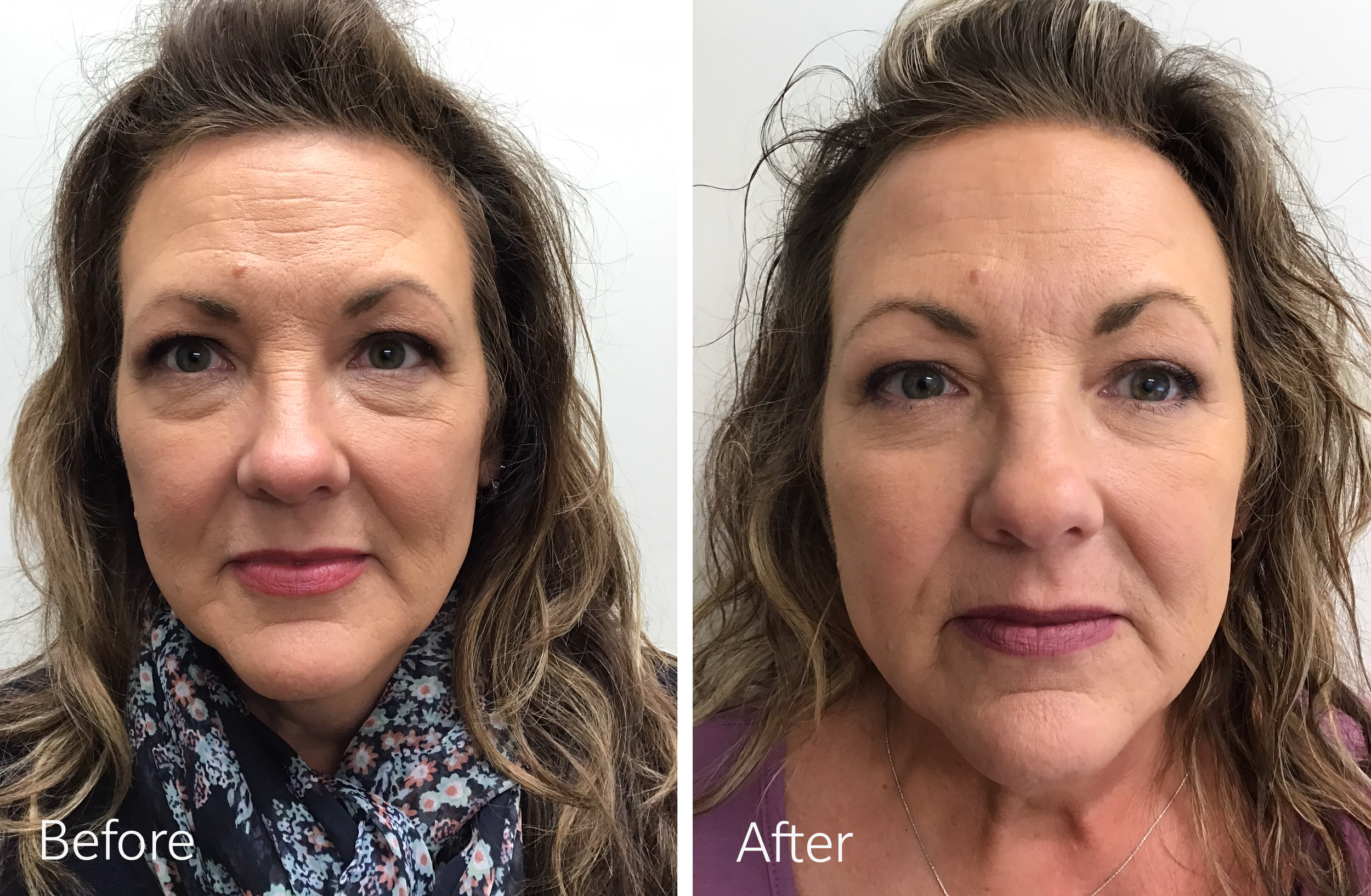 Eyelid surgery by Dr. Steven Porto, Board Certified Plastic Surgeon in Indianapolis, Indiana