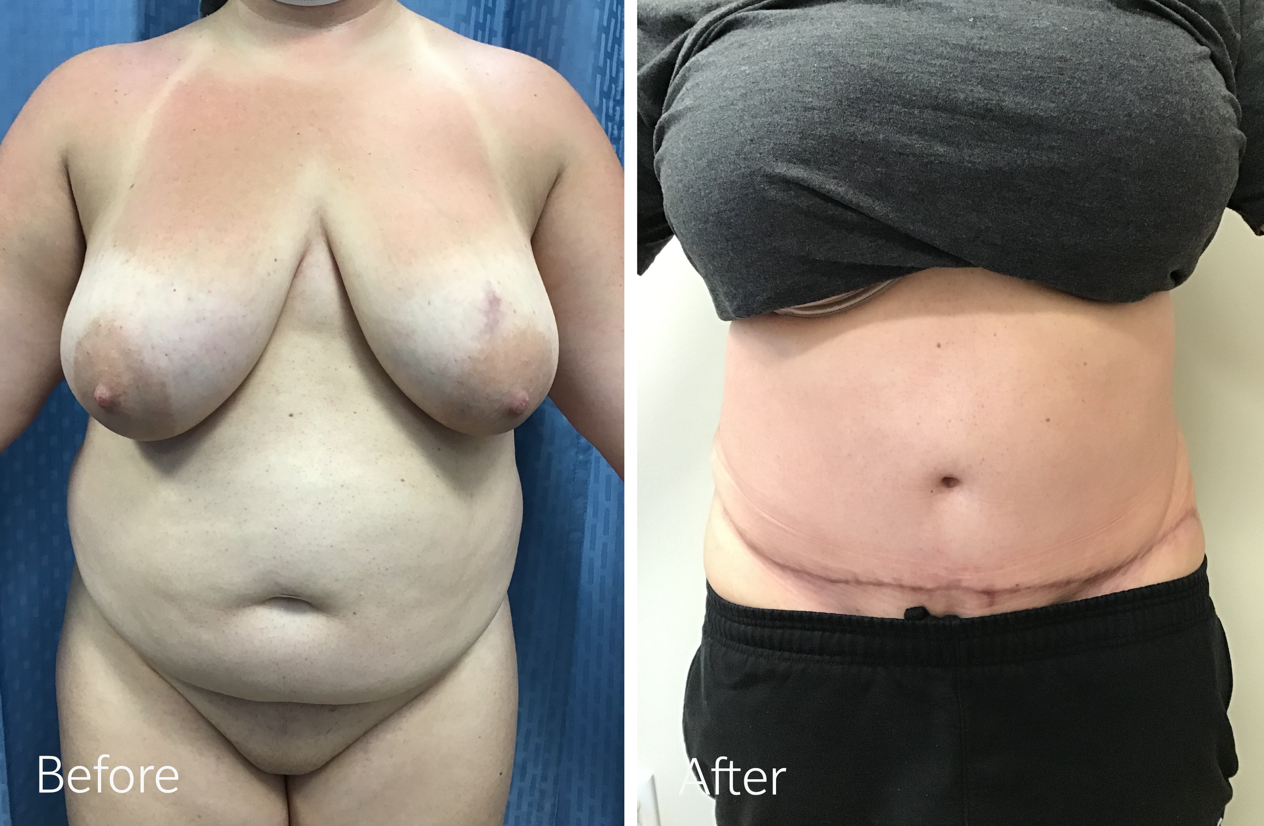 Tummy tuck surgery by Dr. Steven Porto, Board Certified Plastic Surgeon in Indianapolis, Indiana