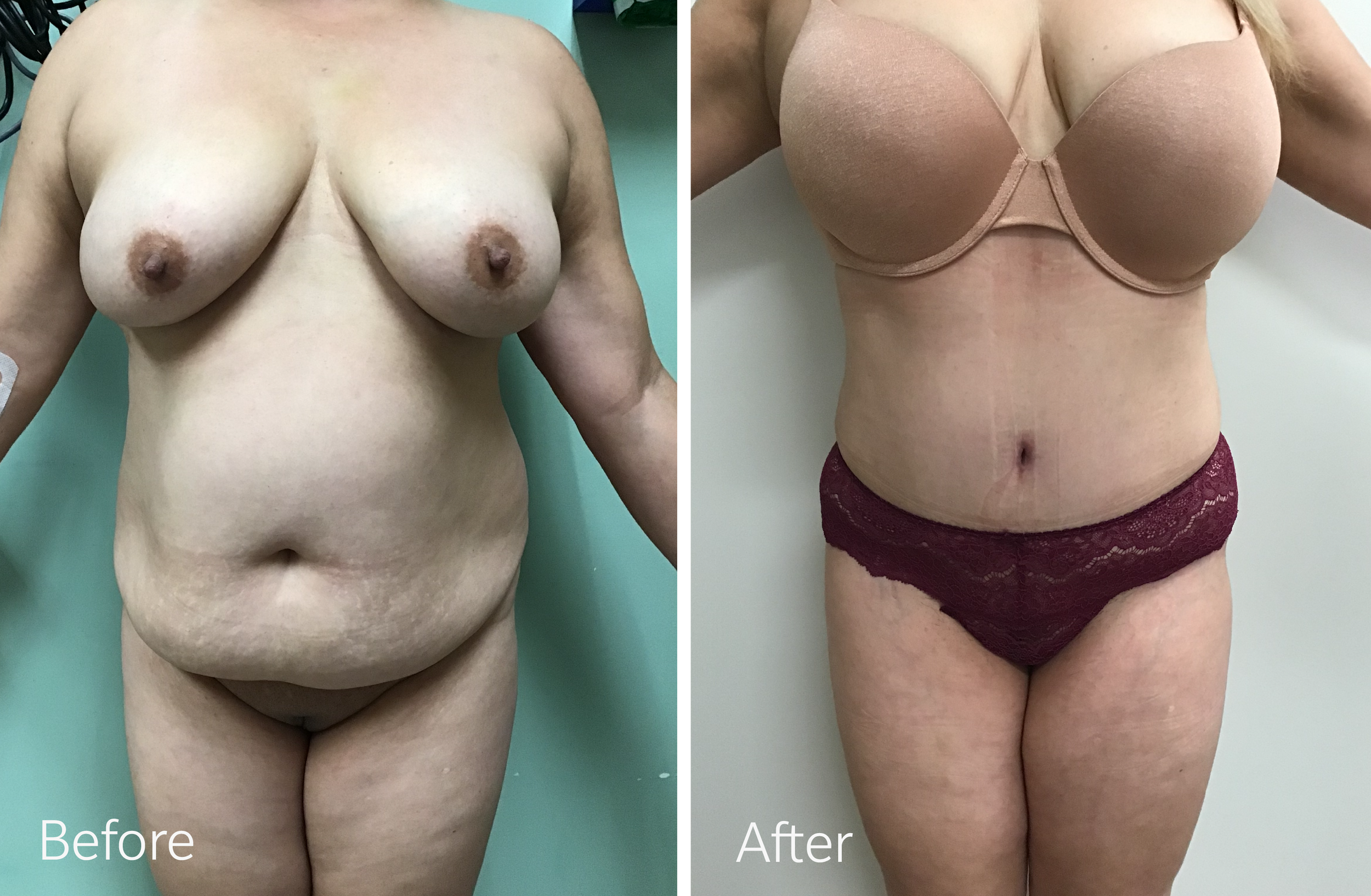Tummy tuck, breast lift and implant surgery by Dr. Steven Porto, Board Certified Plastic Surgeon in Indianapolis, Indiana