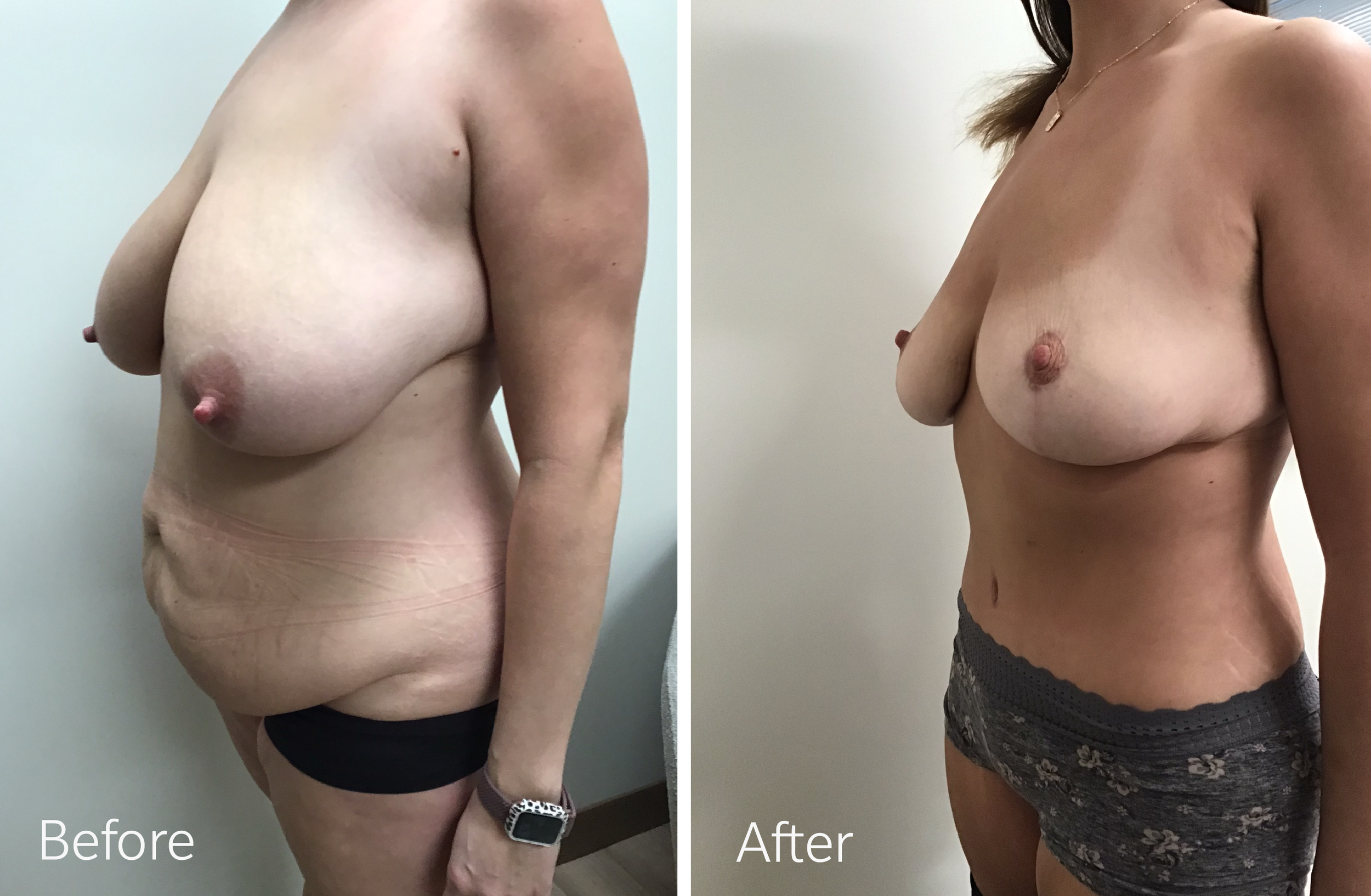 Tummy tuck, breast lift and implant surgery by Dr. Steven Porto, Board Certified Plastic Surgeon in Indianapolis, Indiana