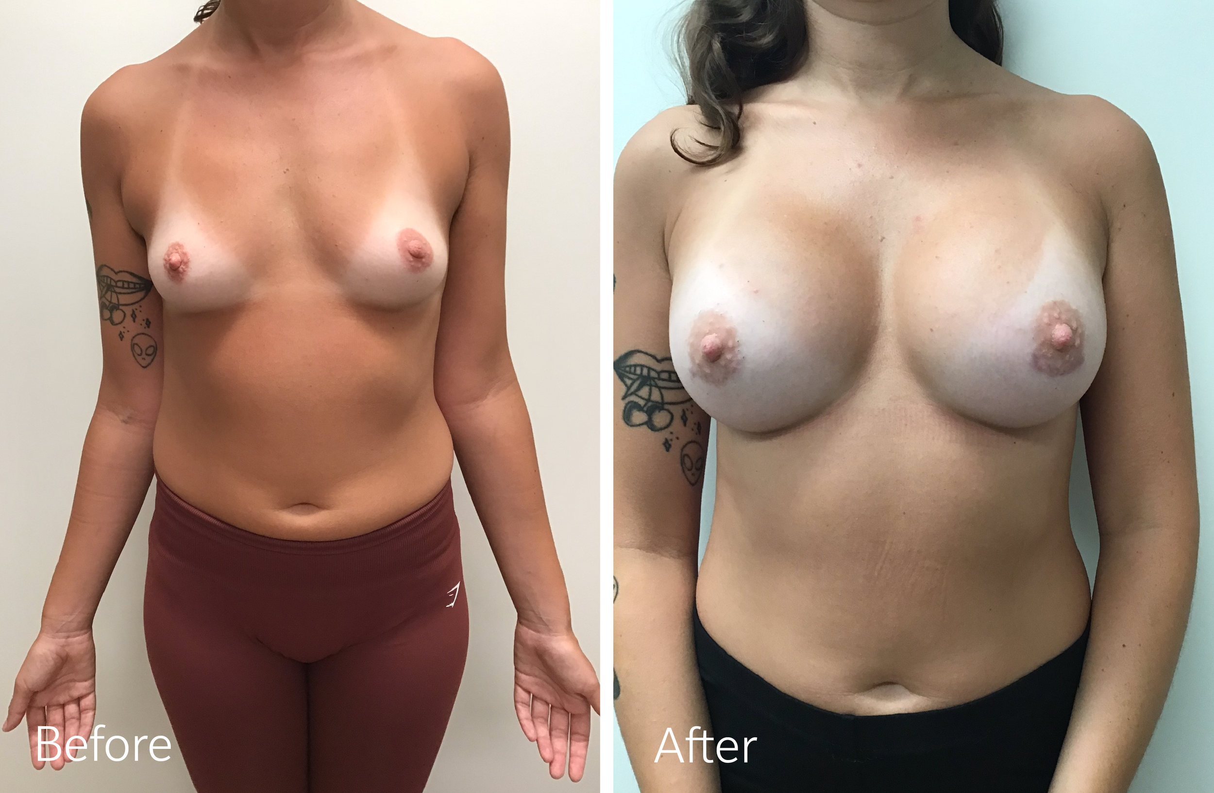 Dr Steven Porto Indianpolis Plastic Surgeon Breast Augmentation