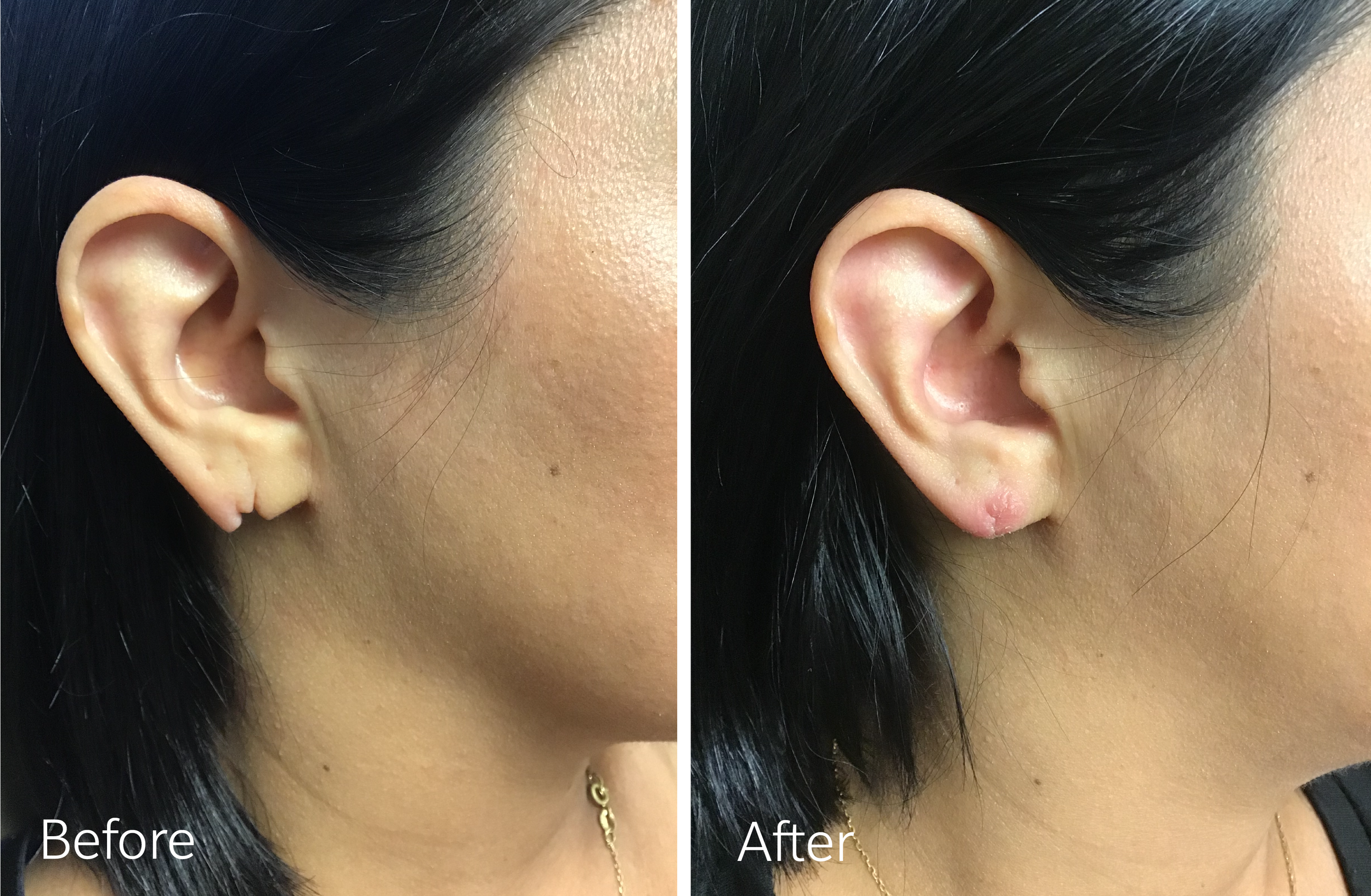 Earlobe repair surgery by Dr. Steven Porto, Board Certified Plastic Surgeon in Indianapolis, Indiana