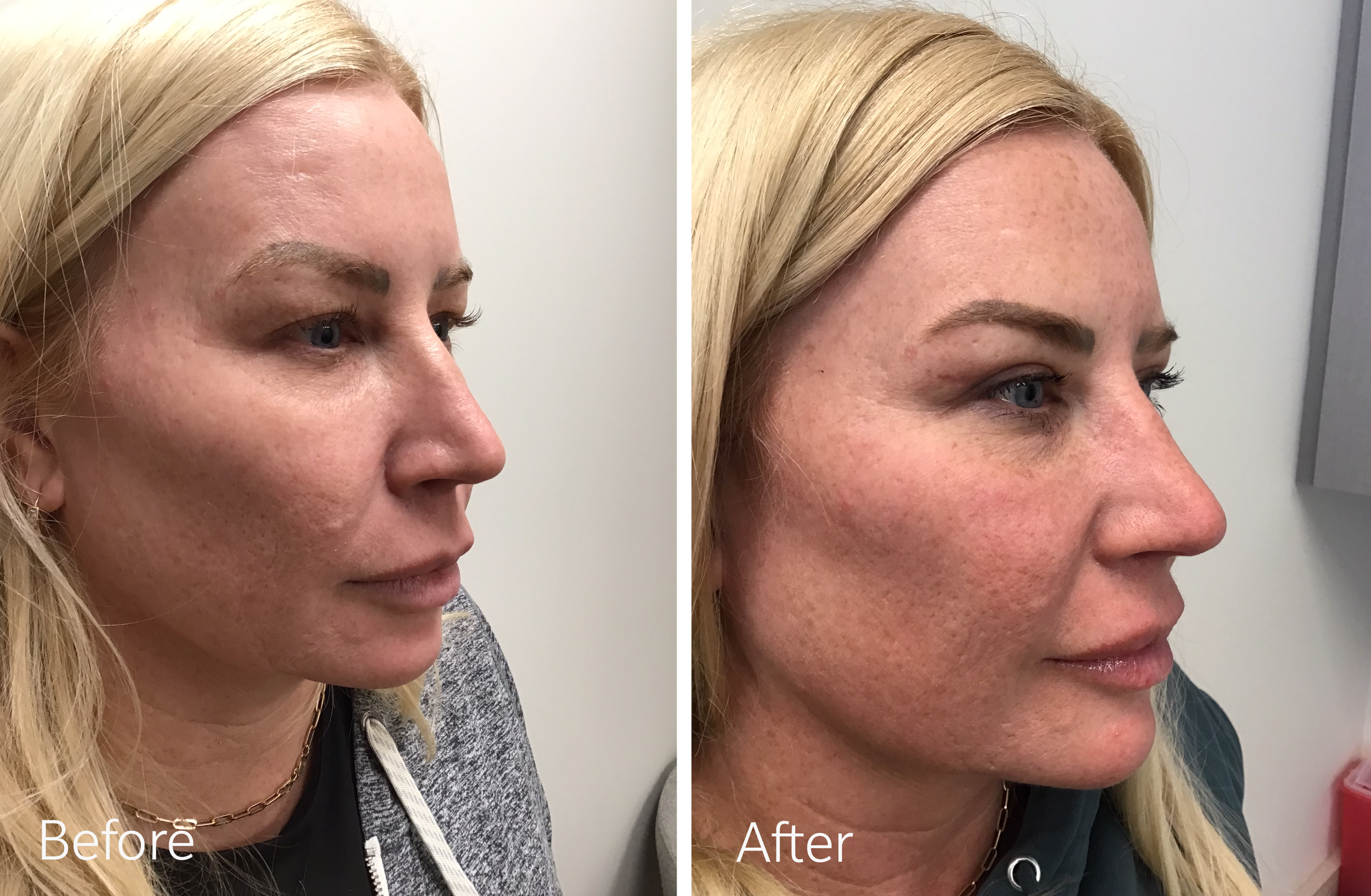 Eyelid surgery by Dr. Steven Porto, Board Certified Plastic Surgeon in Indianapolis, Indiana