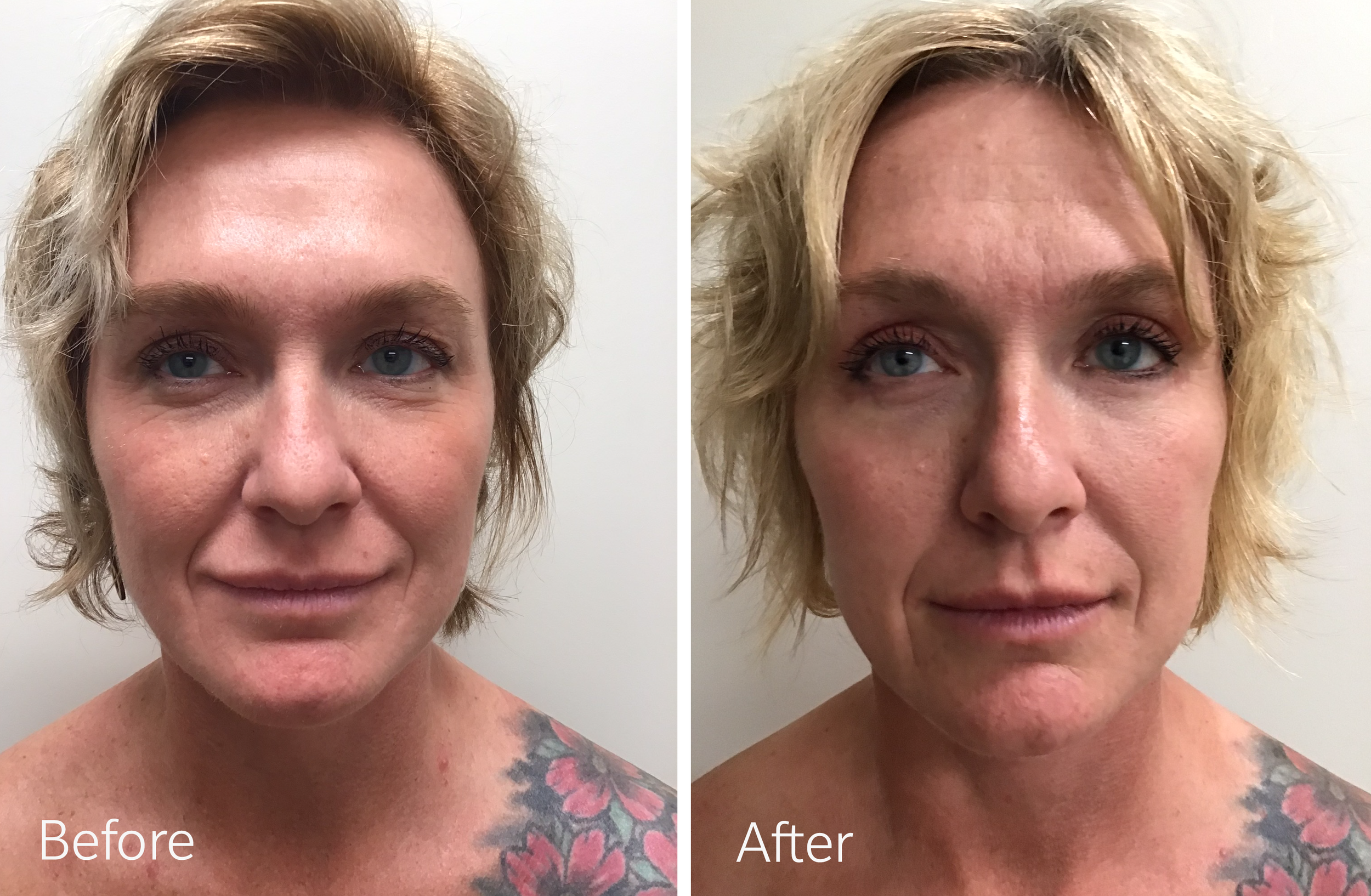 Eyelid surgery by Dr. Steven Porto, Board Certified Plastic Surgeon in Indianapolis, Indiana