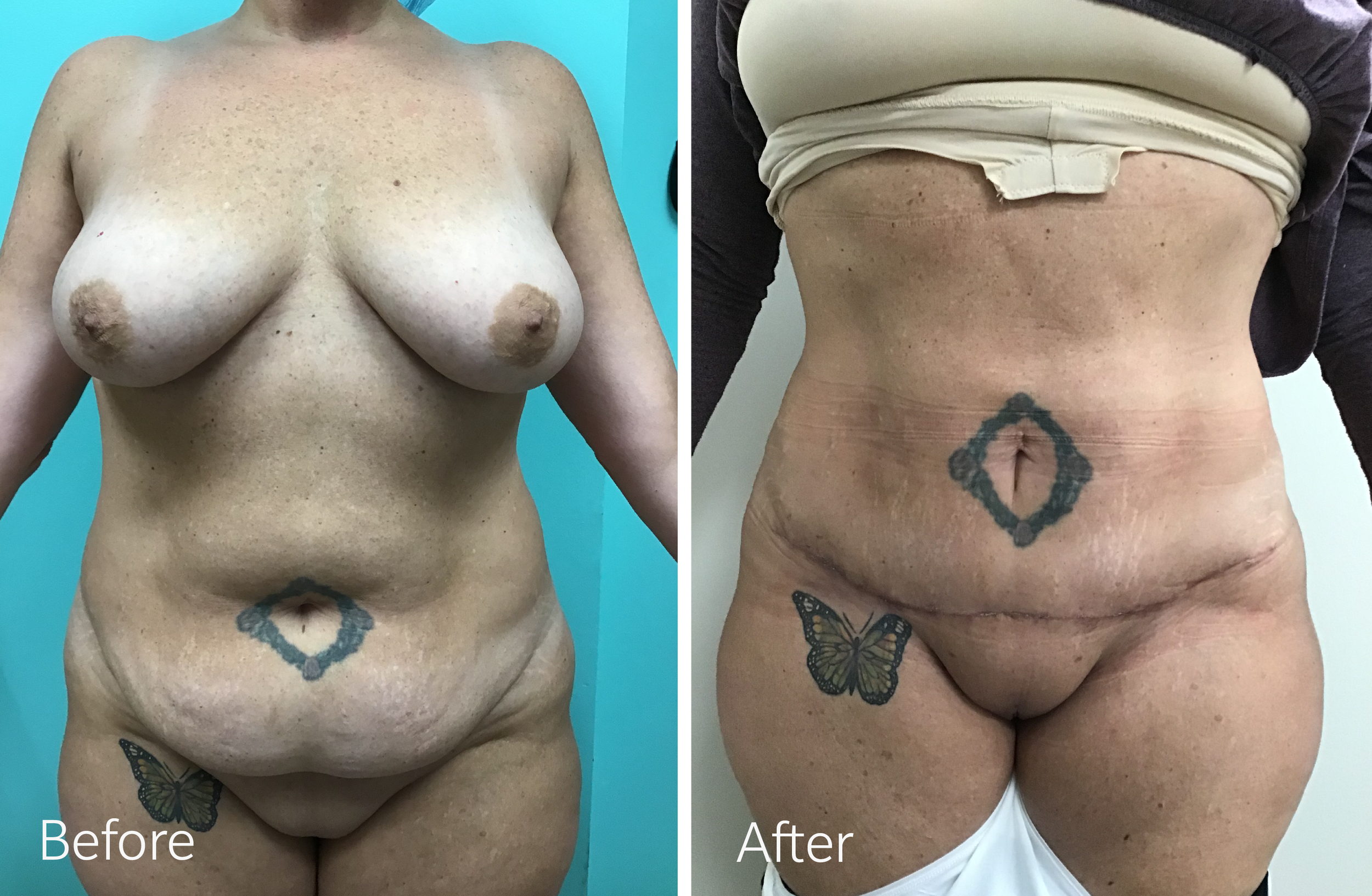 Tummy tuck surgery by Dr. Steven Porto, Board Certified Plastic Surgeon in Indianapolis, Indiana