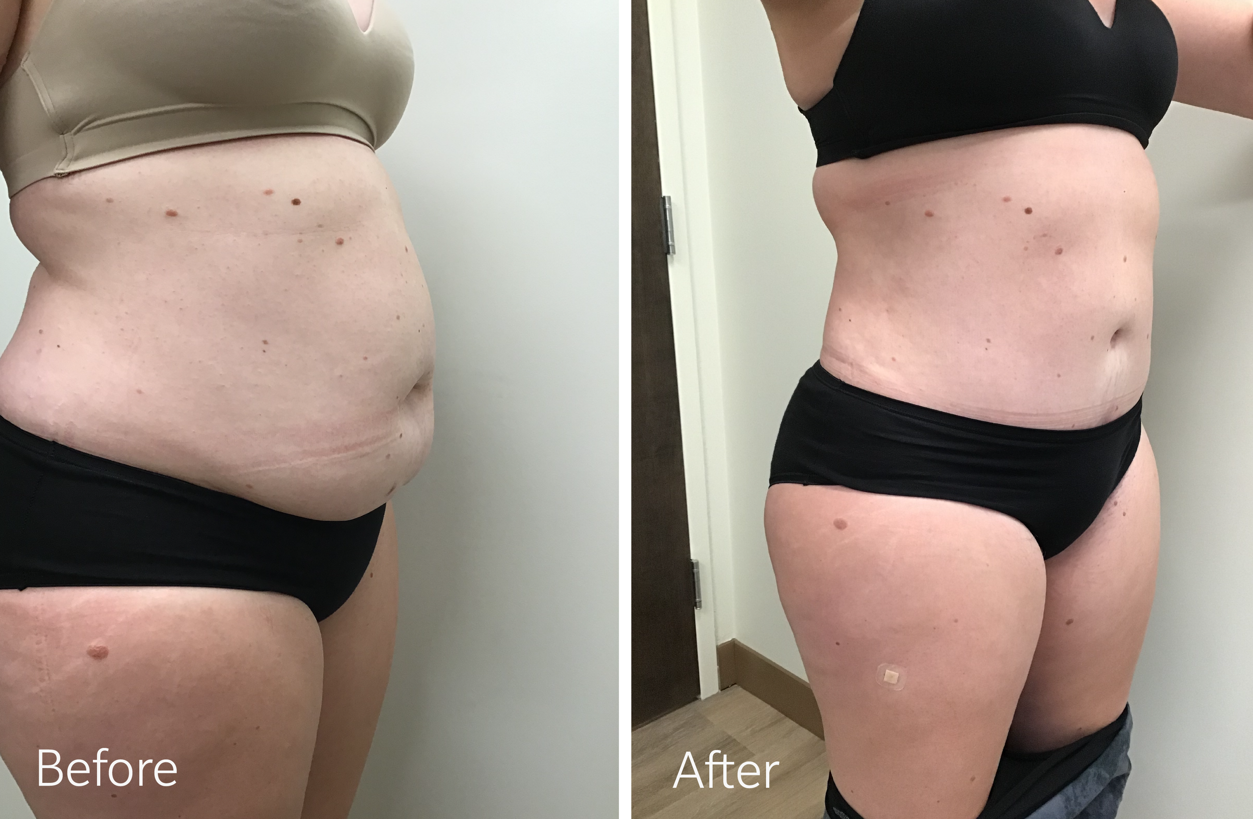 Tummy tuck surgery and vaser liposuction by Dr. Steven Porto, Board Certified Plastic Surgeon in Indianapolis, Indiana