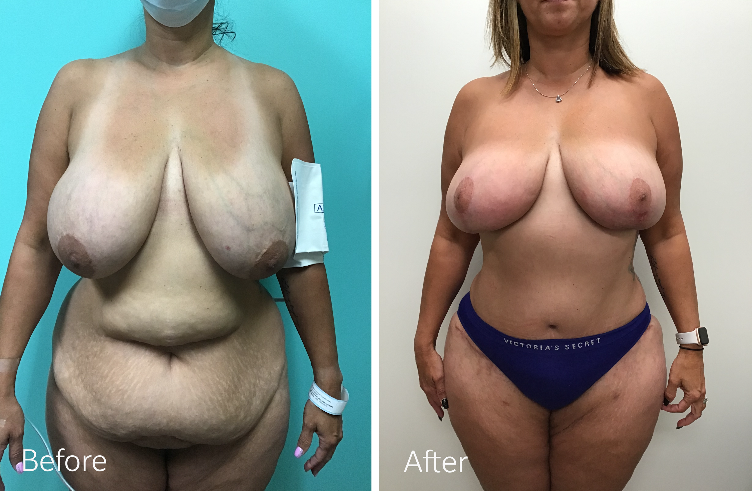 Mommy Makeover Tummy Tuck, Liposuction, Breast Lift and Implants by Dr. Steven Porto, Board Certified Plastic Surgeon in Indianapolis, Indiana