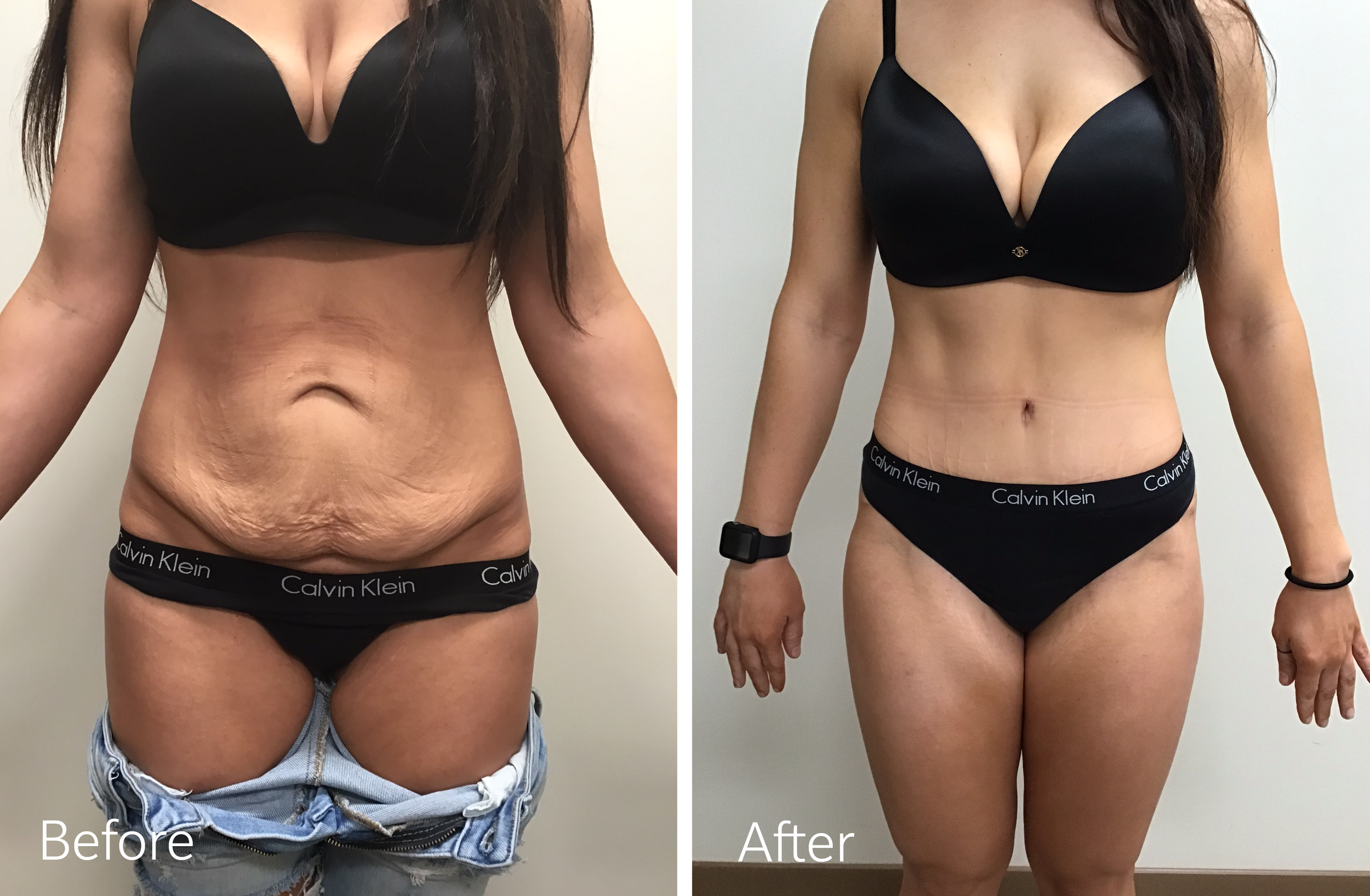 Vaser liposuction plastic surgery by Dr. Steven Porto, Board Certified Plastic Surgeon in Indianapolis, Indiana