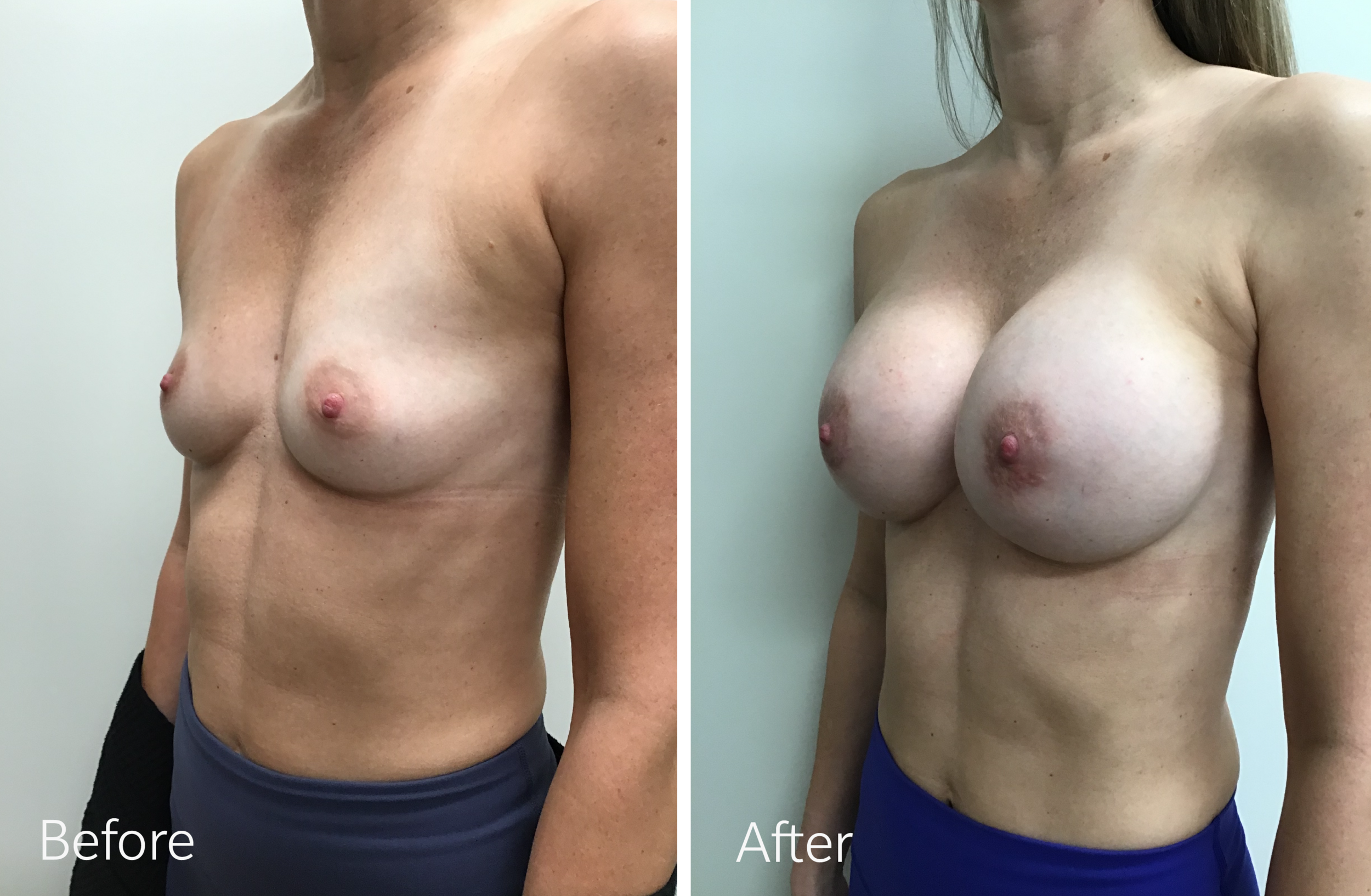 Breast Augmentation Surgery with 350cc Implants by Dr. Steven Porto