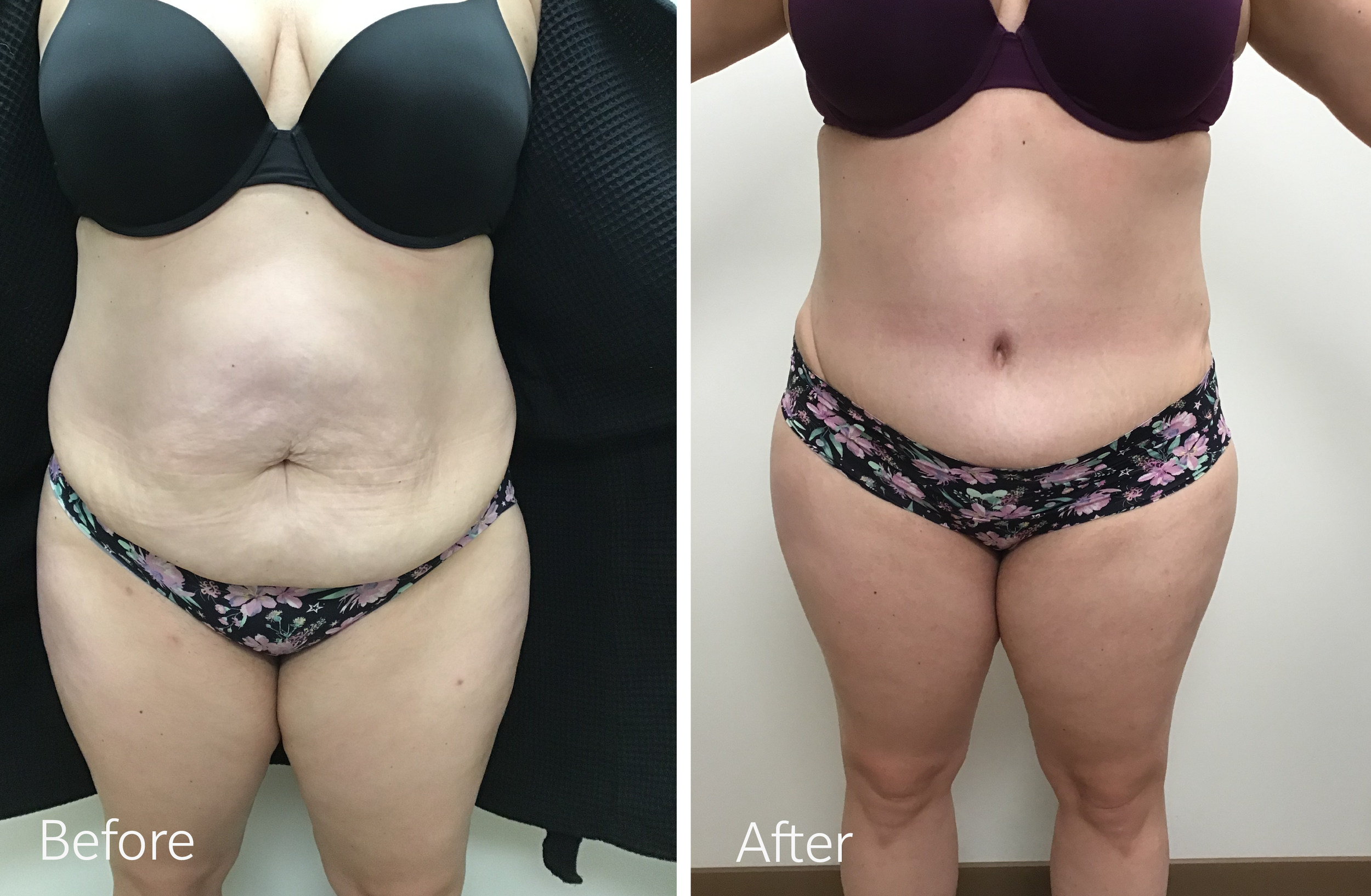 Tummy tuck, breast lift and implant surgery by Dr. Steven Porto, Board Certified Plastic Surgeon in Indianapolis, Indiana