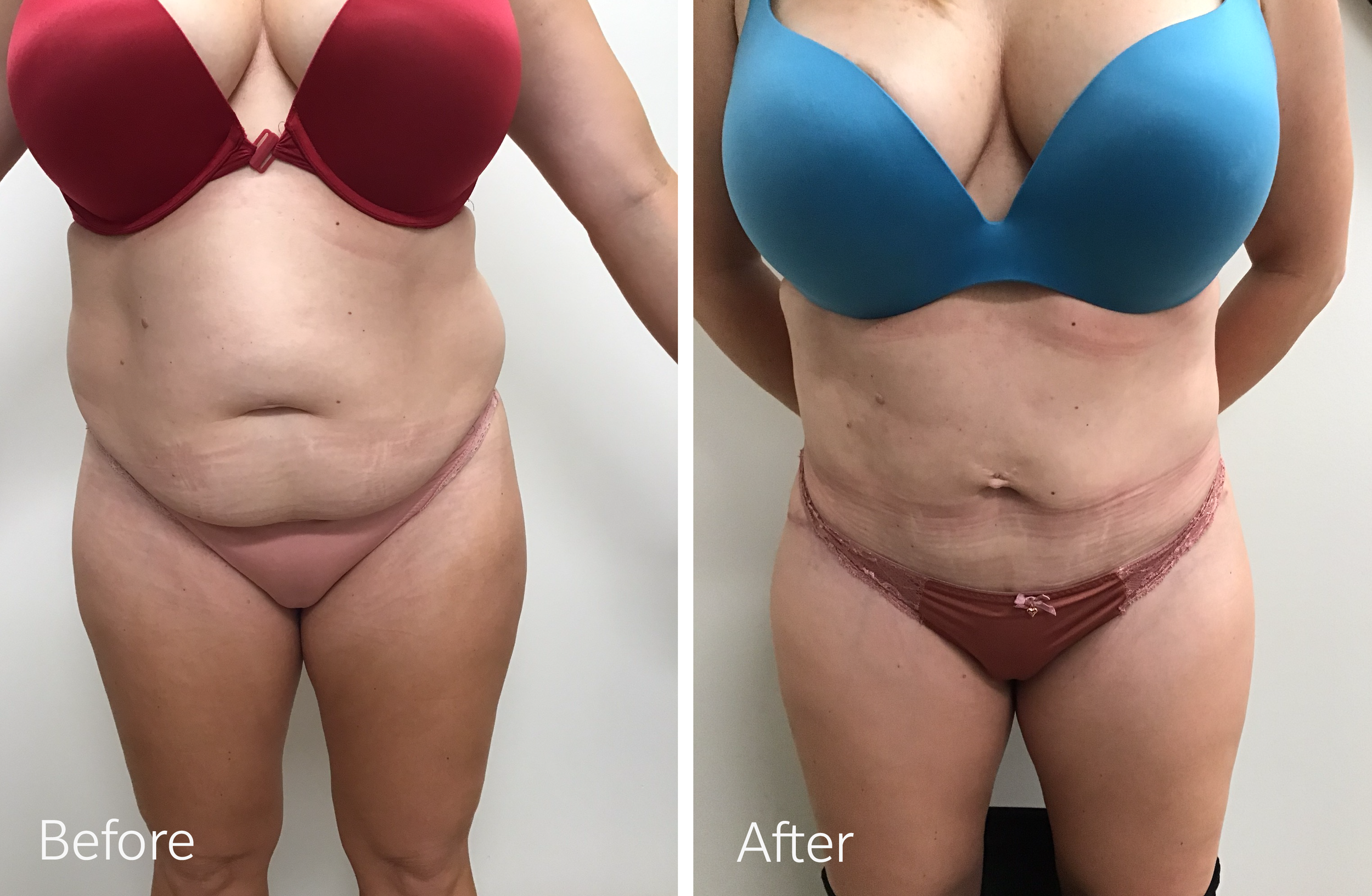 Tummy tuck, breast lift and implant surgery by Dr. Steven Porto, Board Certified Plastic Surgeon in Indianapolis, Indiana