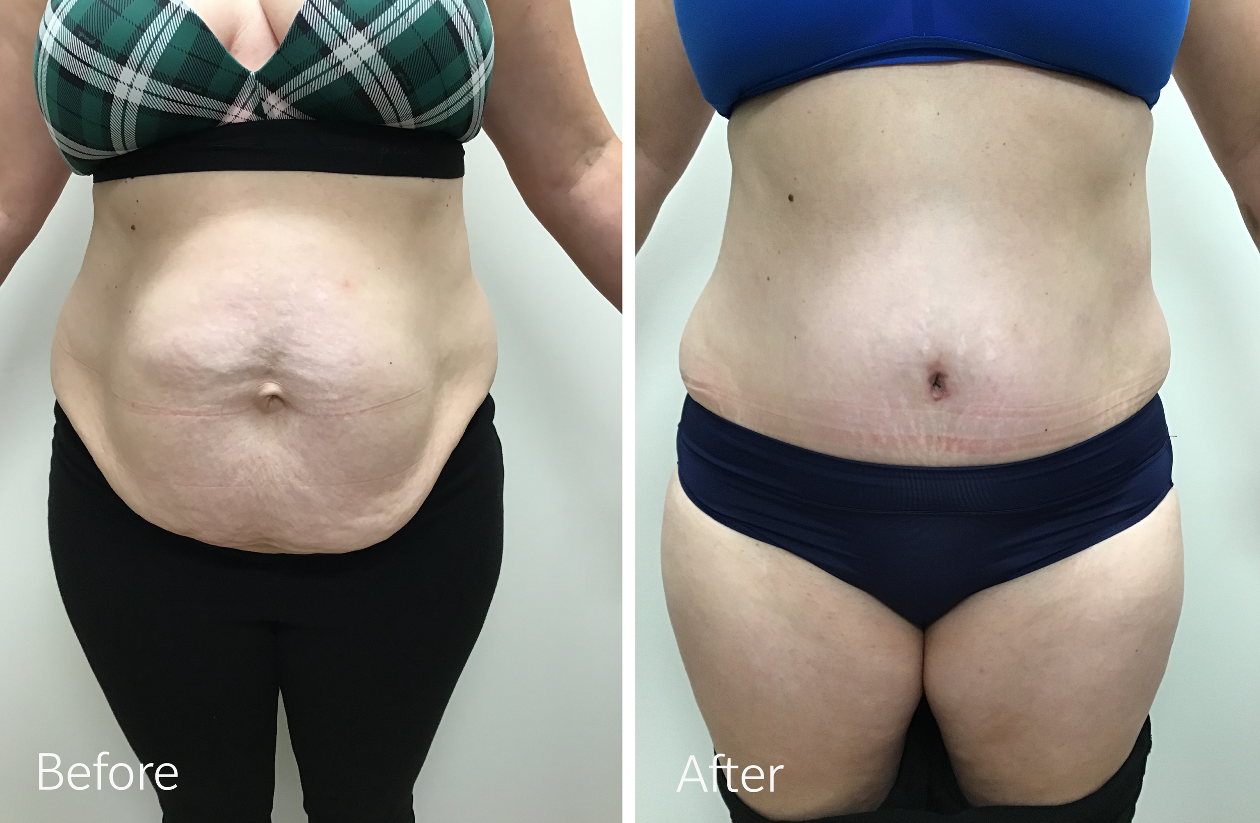 Tummy tuck surgery by Dr. Steven Porto, Board Certified Plastic Surgeon in Indianapolis, Indiana