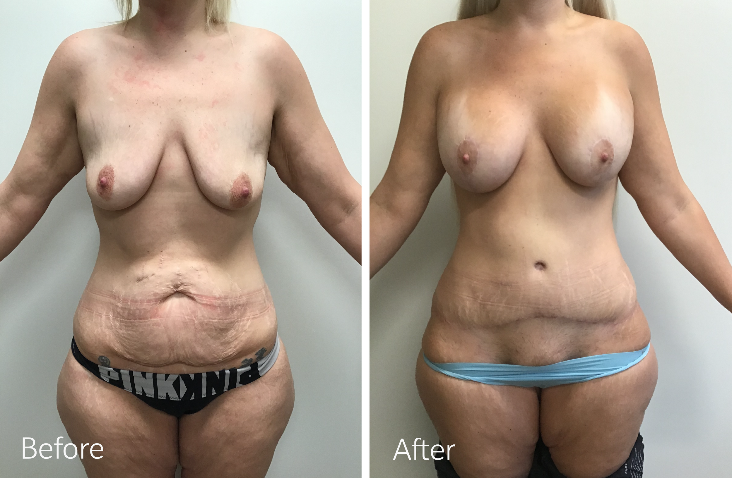 Tummy tuck, breast lift and implant surgery by Dr. Steven Porto, Board Certified Plastic Surgeon in Indianapolis, Indiana