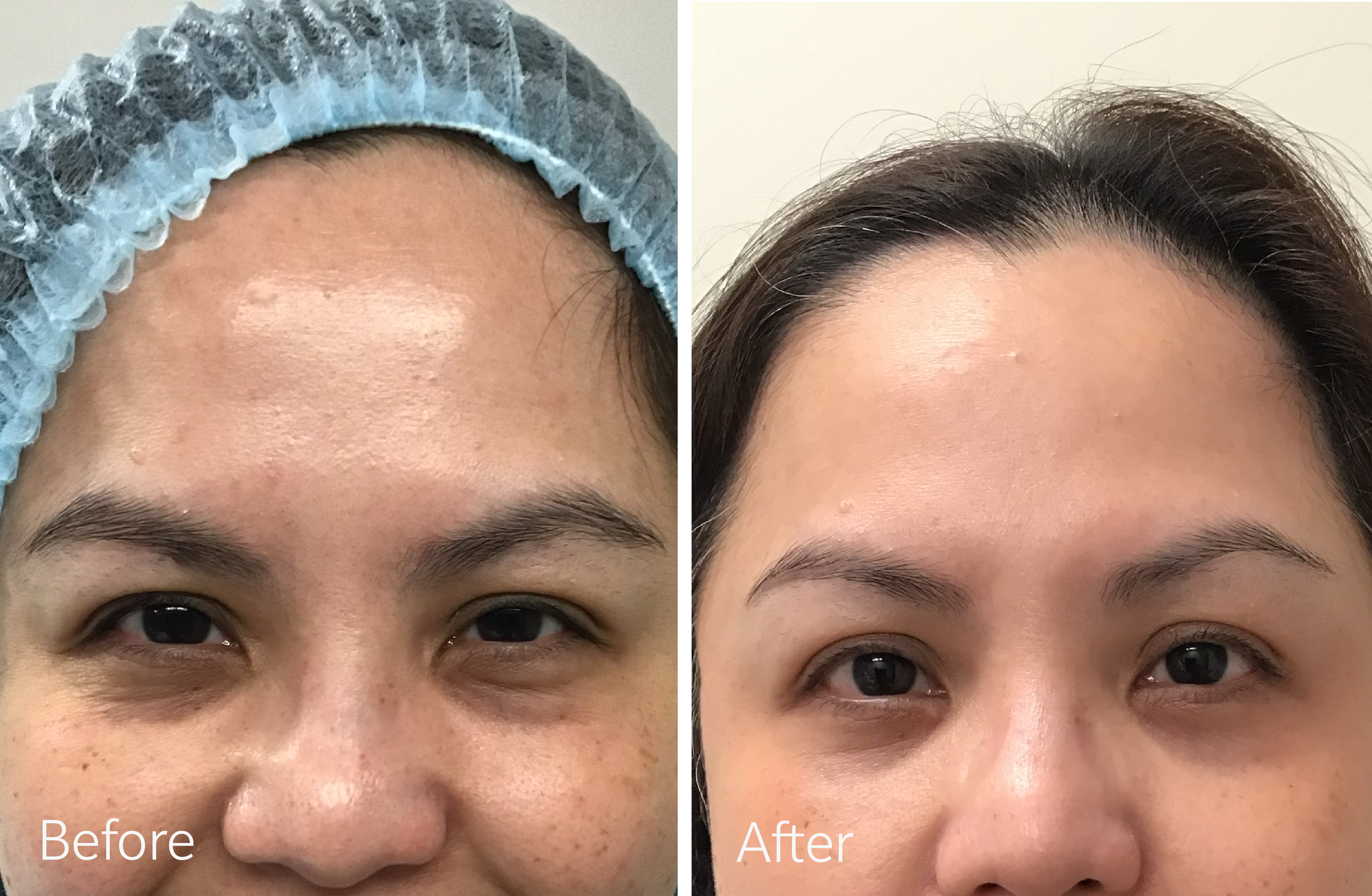 Eyelid surgery by Dr. Steven Porto, Board Certified Plastic Surgeon in Indianapolis, Indiana