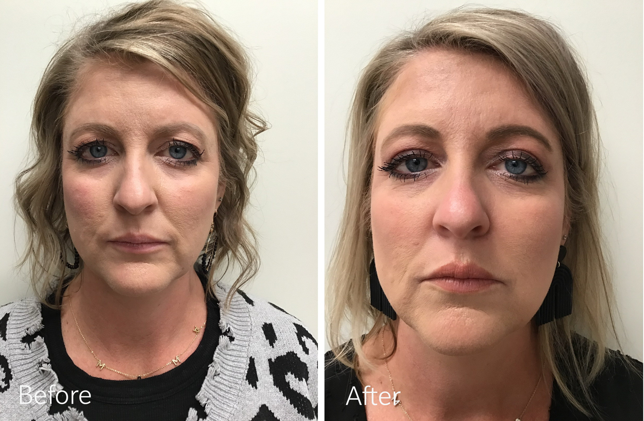 Eyelid surgery by Dr. Steven Porto, Board Certified Plastic Surgeon in Indianapolis, Indiana