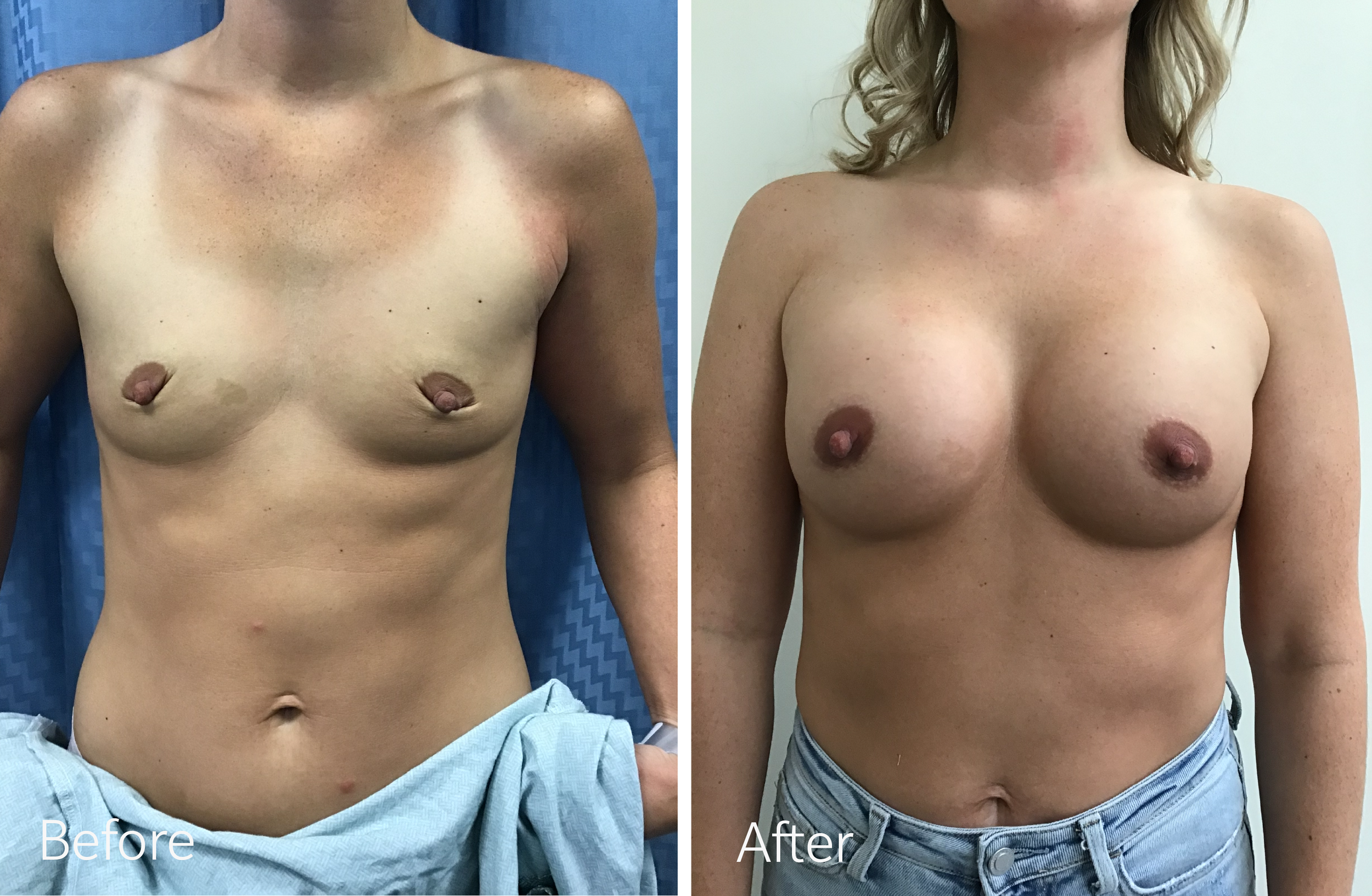 Breast Augmentation Surgery with 325cc Implants by Dr. Steven Porto