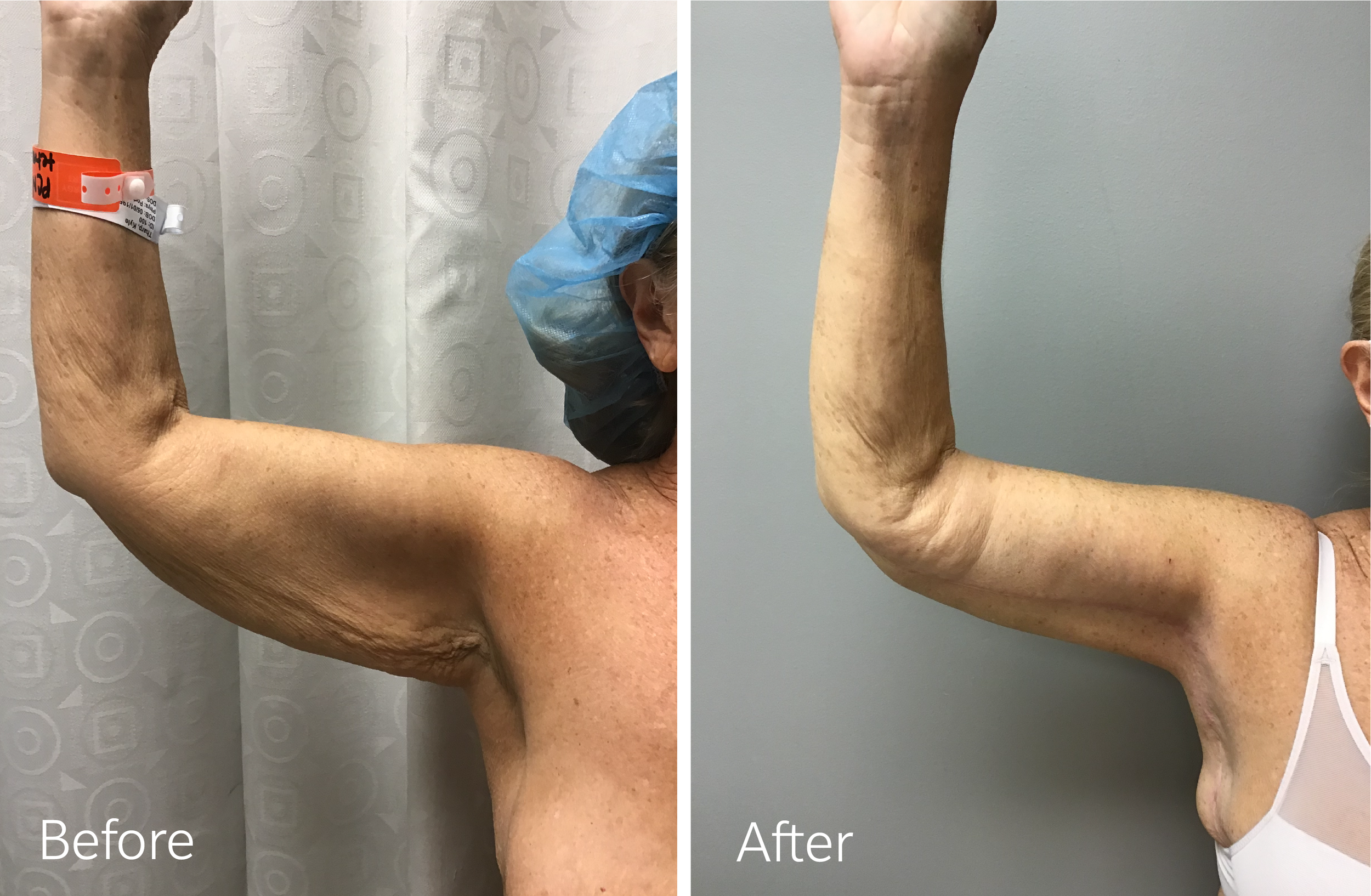 Arm skin removal surgery by Dr. Steven Porto, Board Certified Plastic Surgeon in Indianapolis, Indiana