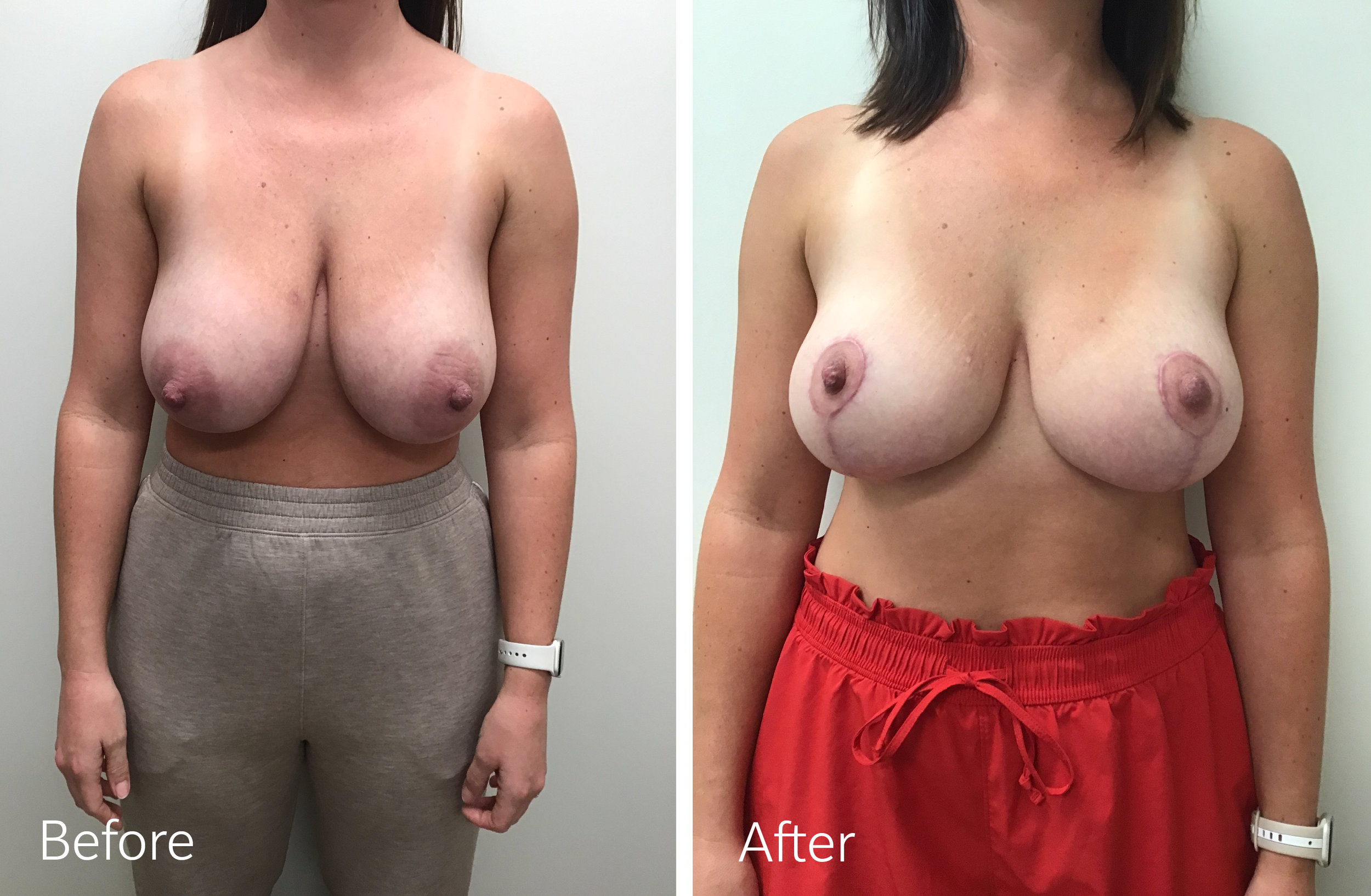 Female breast lift cosmetic procedure in Fishers, Indiana by the best plastic surgeon in Indiana Dr. Steven Porto