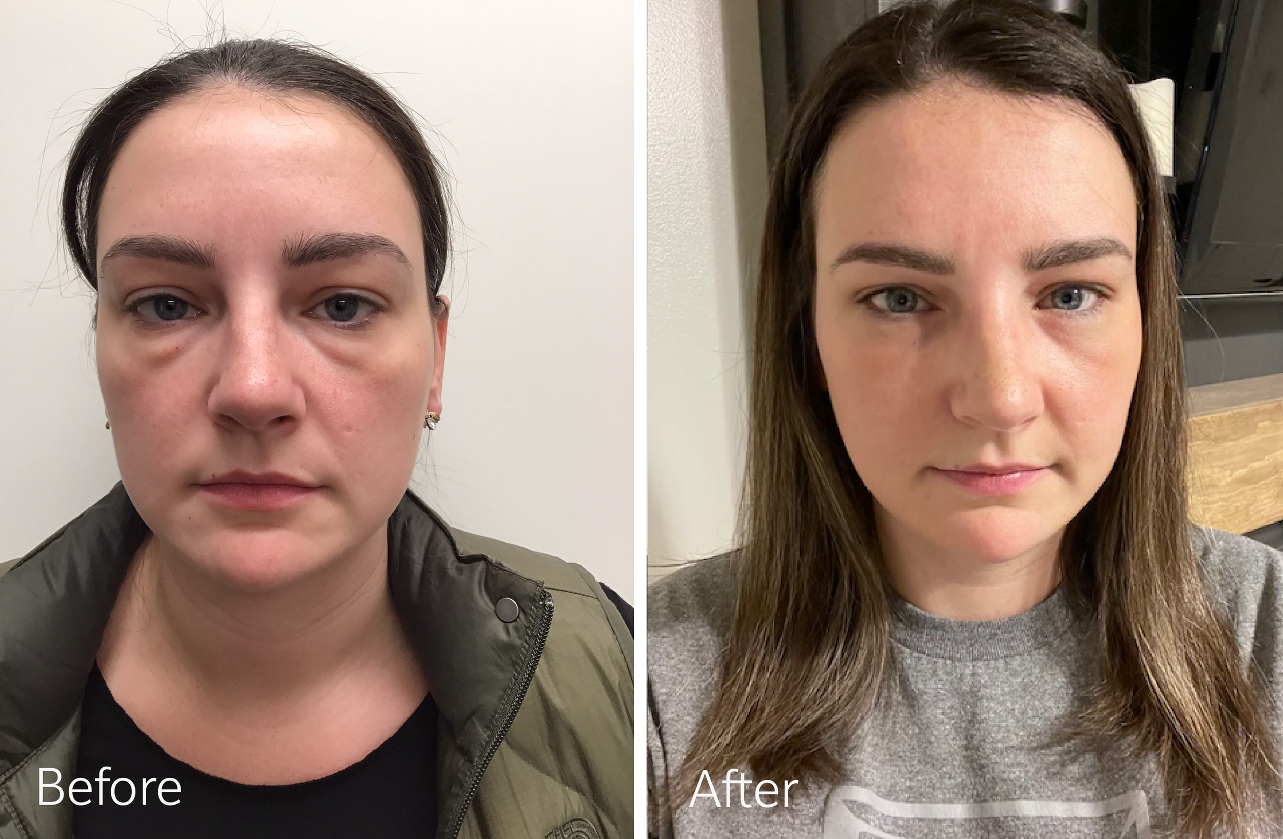 Eyelid surgery by Dr. Steven Porto, Board Certified Plastic Surgeon in Indianapolis, Indiana