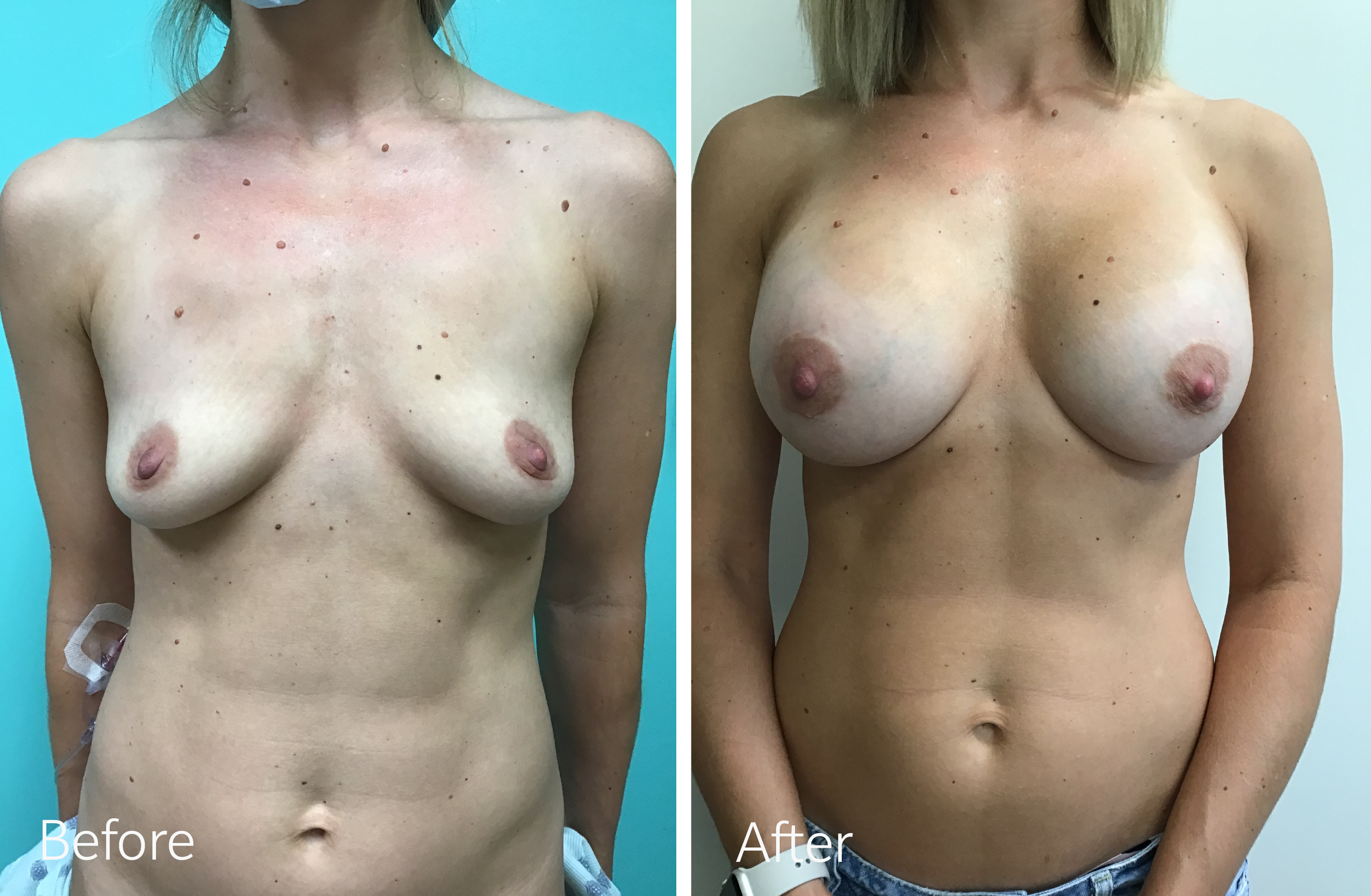 Breast Augmentation Surgery with 430cc Implants by Dr. Steven Porto