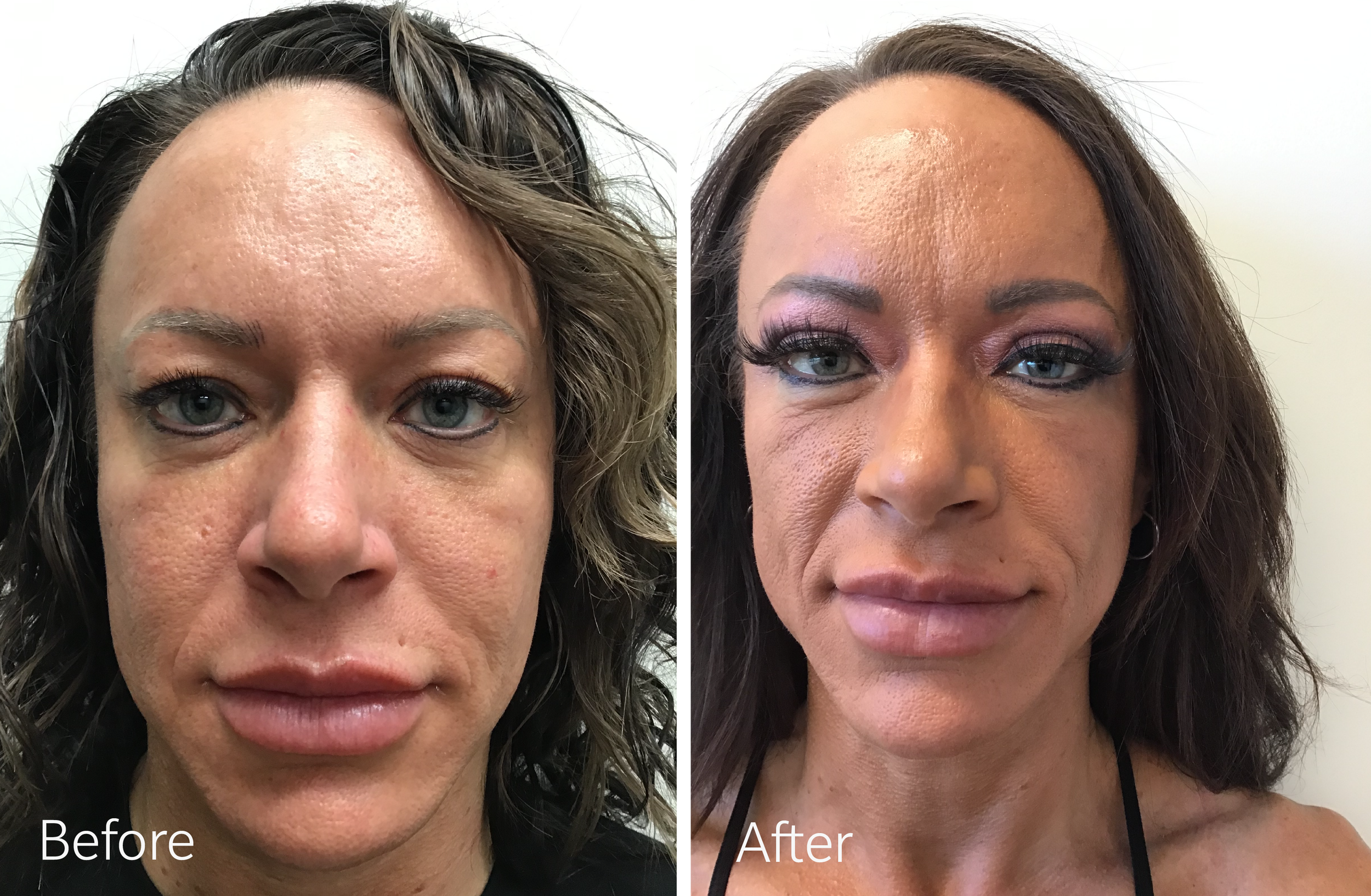 Eyelid surgery by Dr. Steven Porto, Board Certified Plastic Surgeon in Indianapolis, Indiana