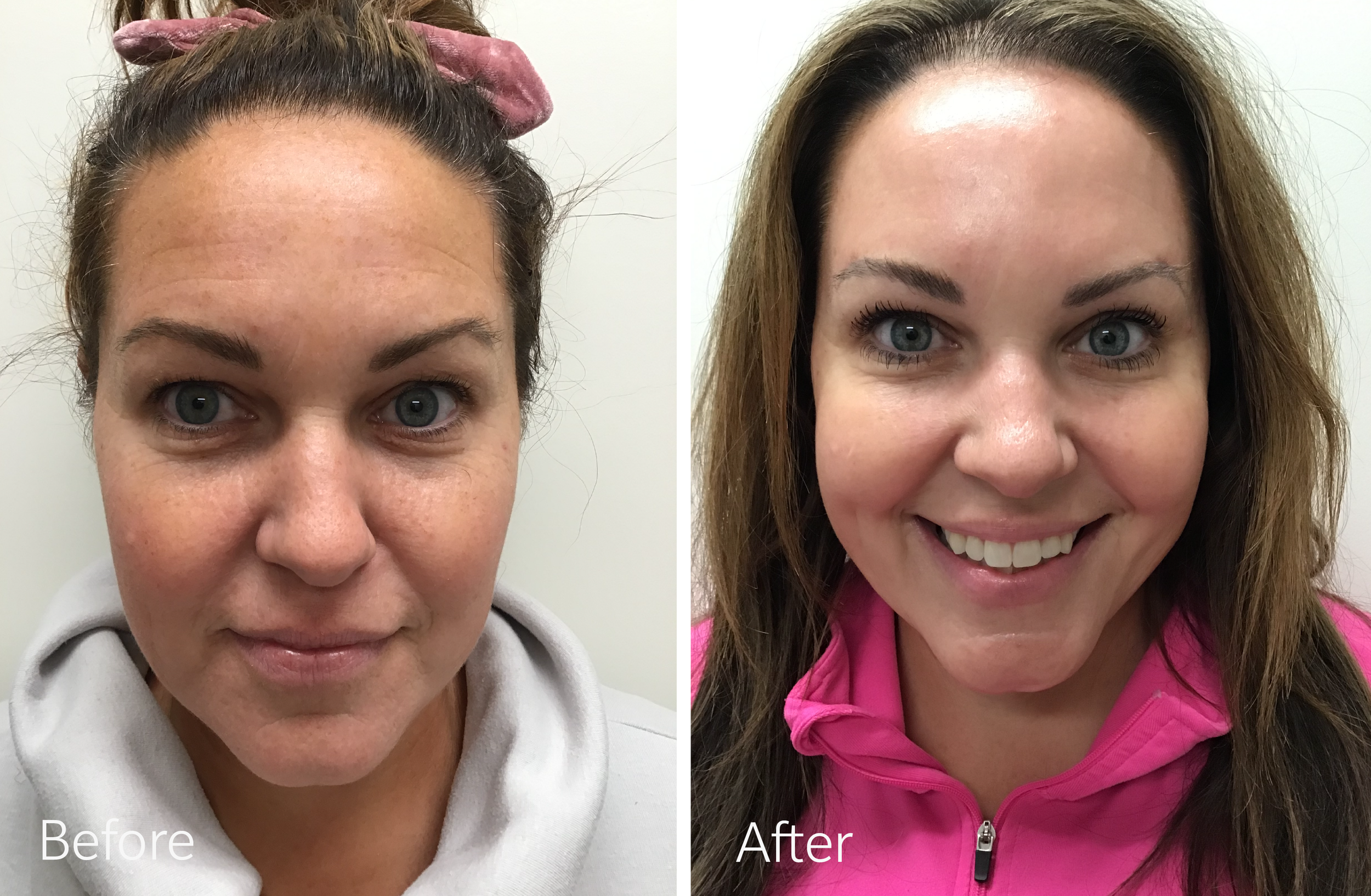 Eyebrow surgery by Dr. Steven Porto, Board Certified Plastic Surgeon in Indianapolis, Indiana