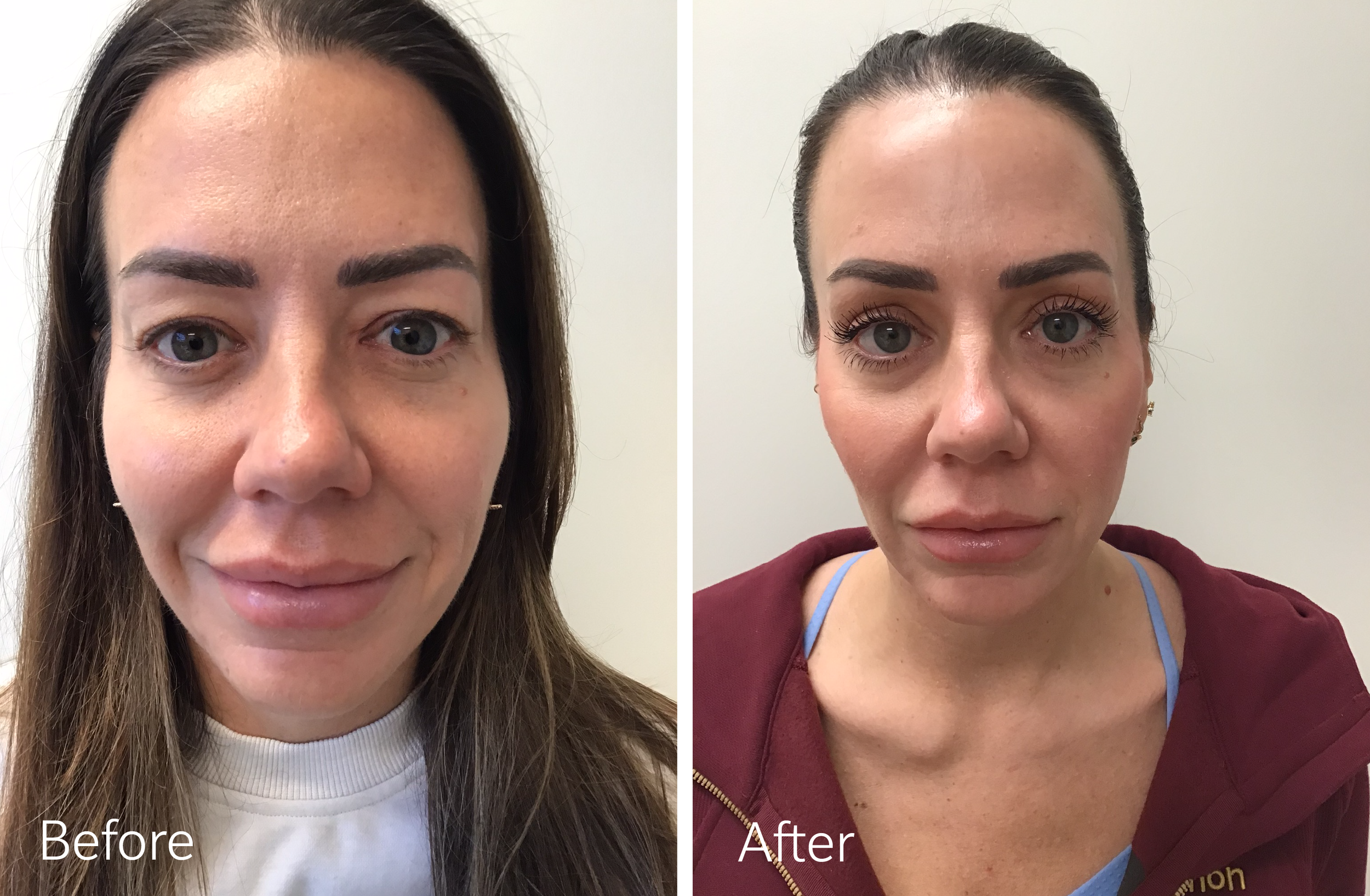 Eyelid Surgery by Dr. Steven Porto, Plastic Surgeon in Fishers, Indiana