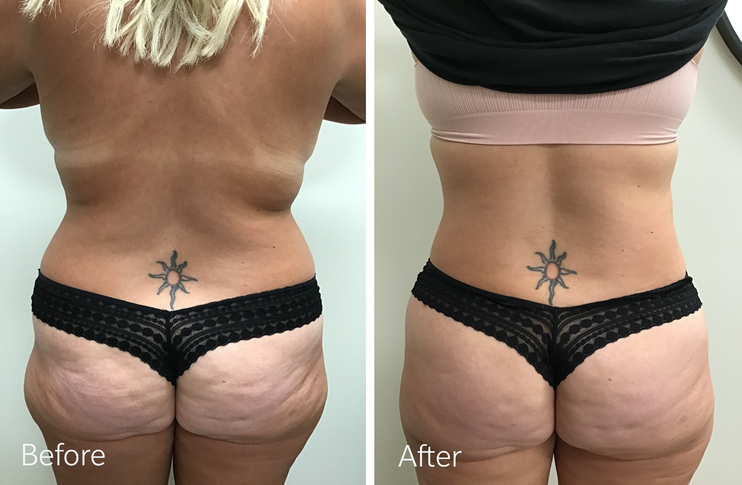 Vaser liposuction surgery by Dr. Steven Porto, Board Certified Plastic Surgeon in Indianapolis, Indiana