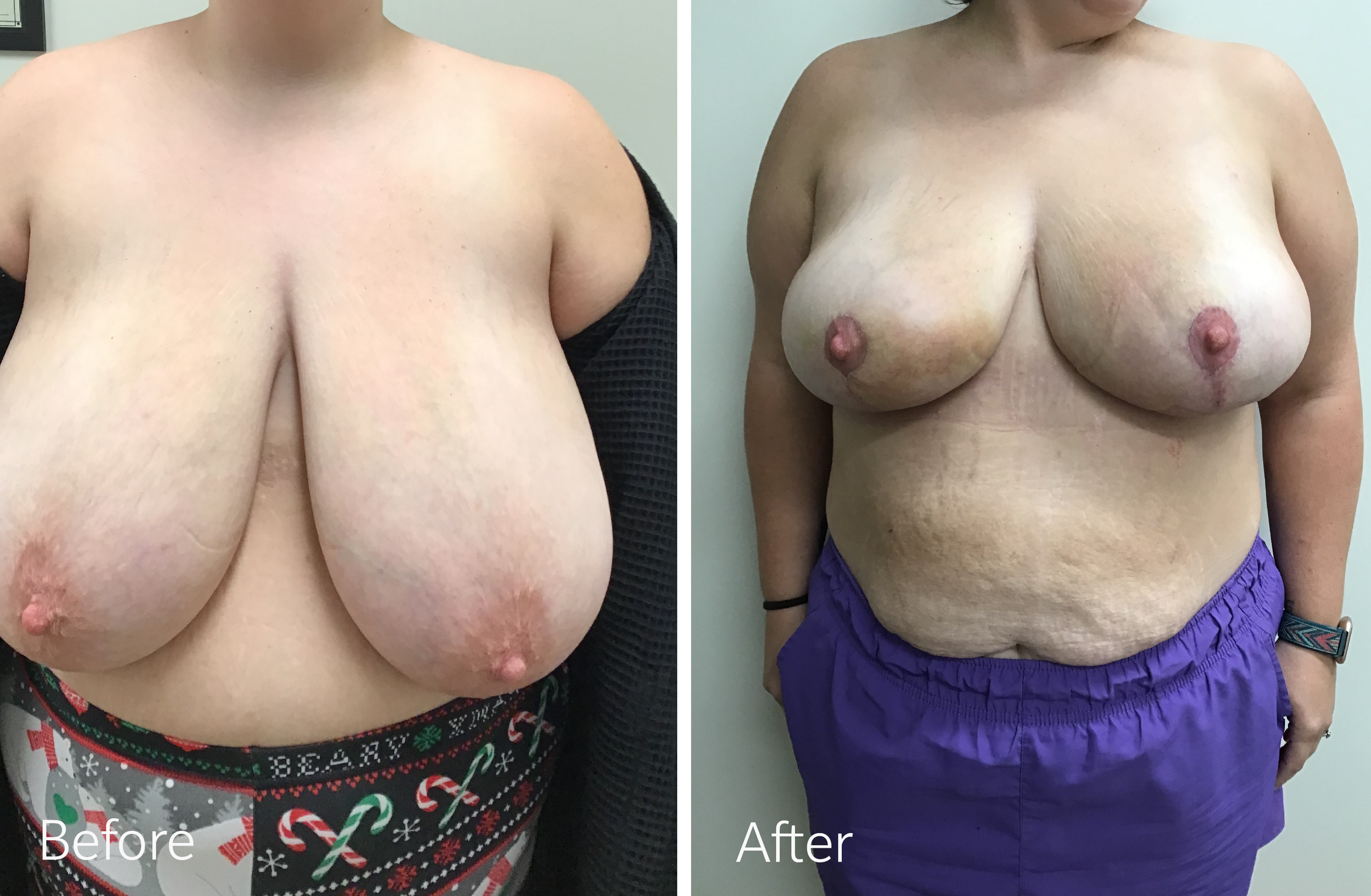 Breast reduction surgery by Dr. Steven Porto