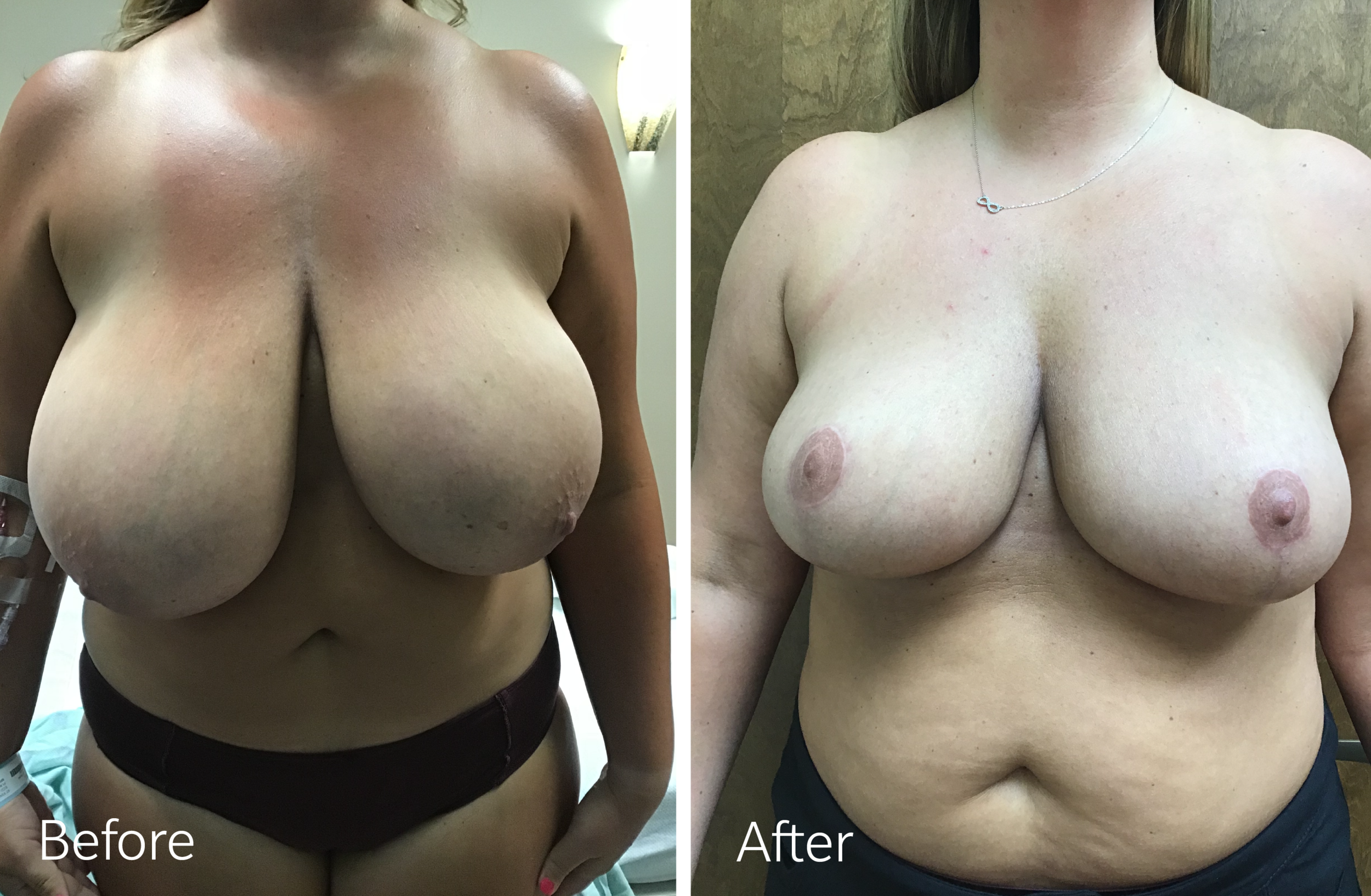 Breast reduction surgery by Dr. Steven Porto