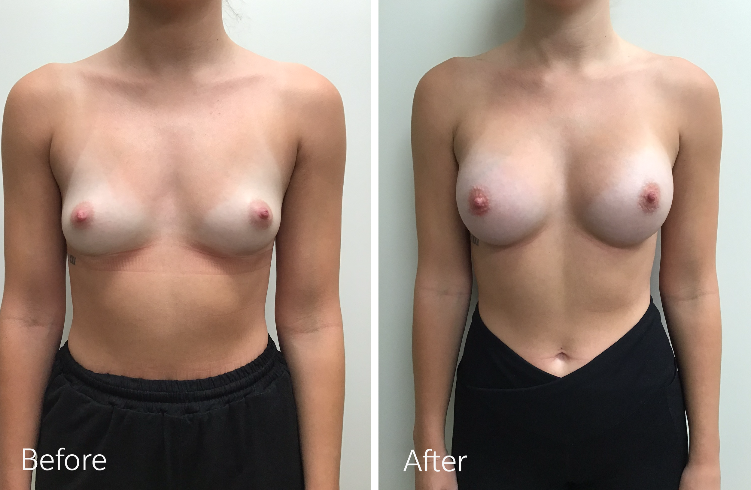 Breast Augmentation Surgery with 295cc Implants by Dr. Steven Porto