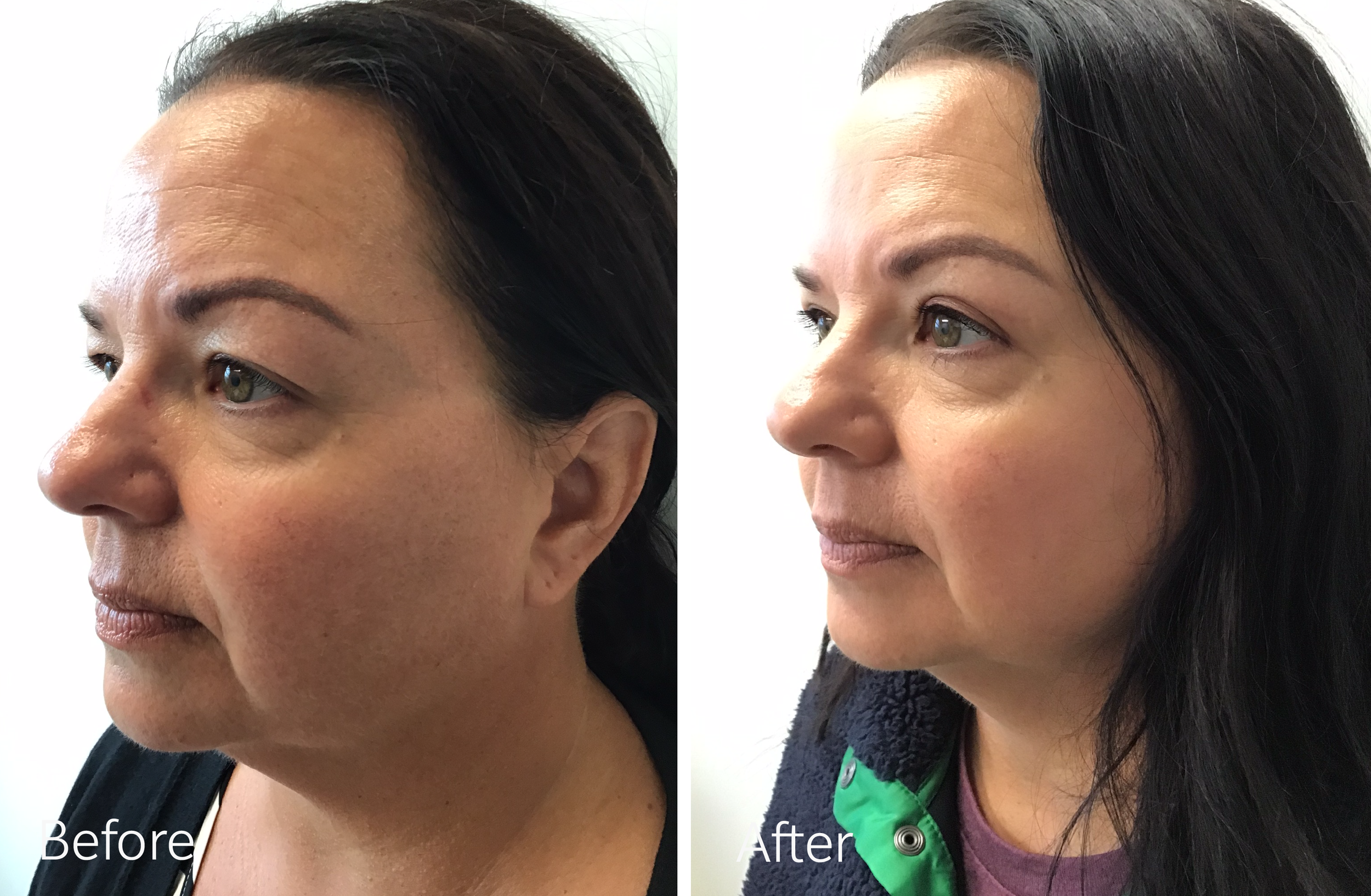 Eyelid surgery by Dr. Steven Porto, Board Certified Plastic Surgeon in Indianapolis, Indiana