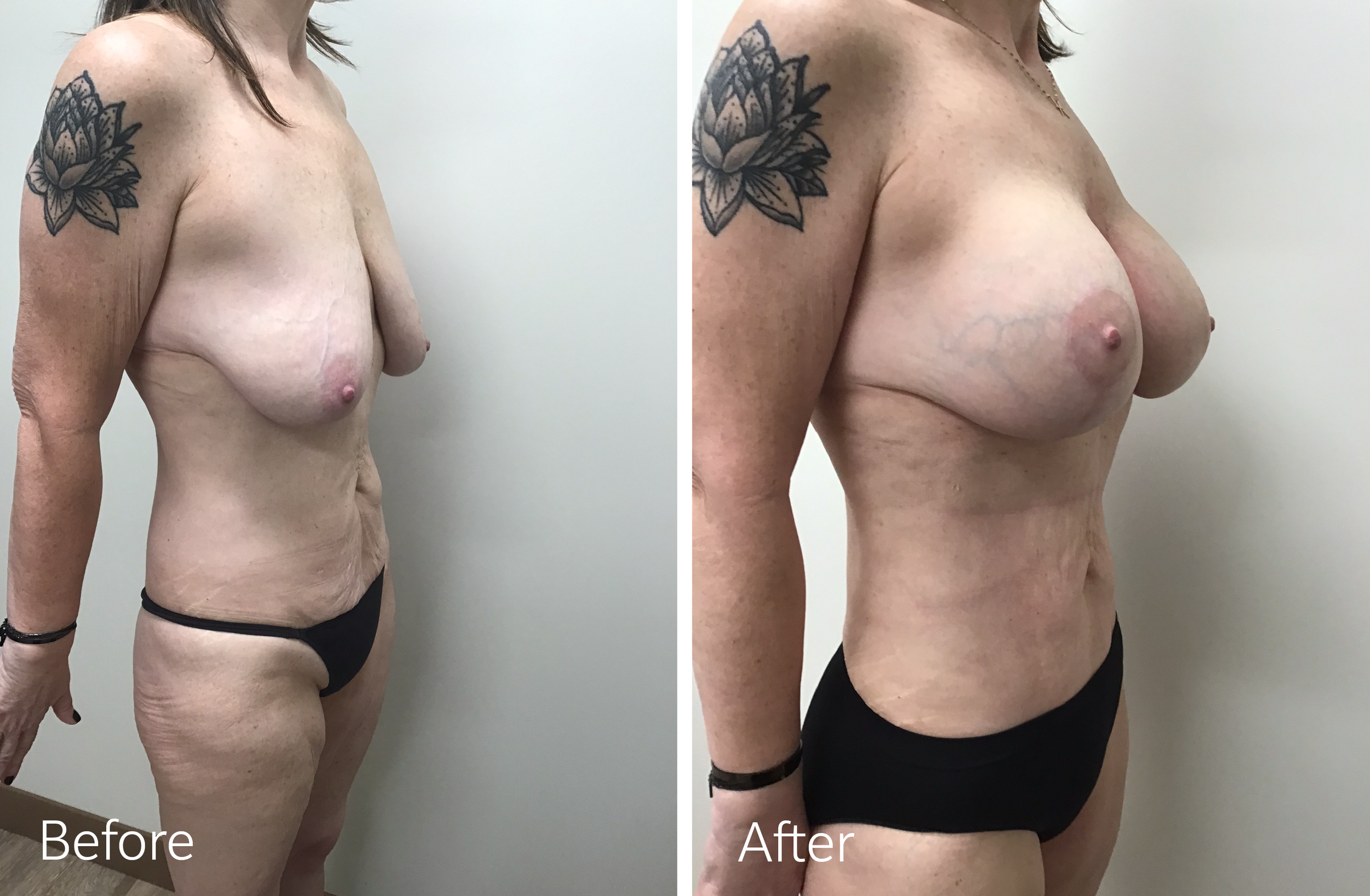 Vaser Liposuction and Tummy Tuck surgery by Dr. Steven Porto Plastic Surgeon in Fishers, Indiana