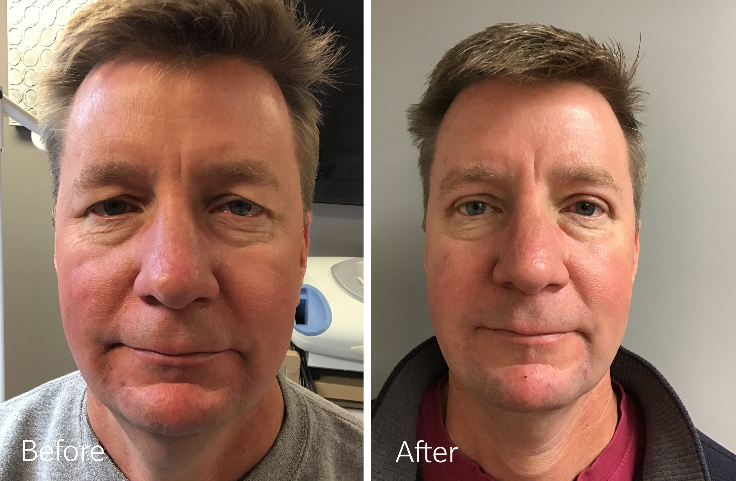 Eyelid lift surgery by Dr. Steven Porto, Board Certified Plastic Surgeon in Indianapolis, Indiana