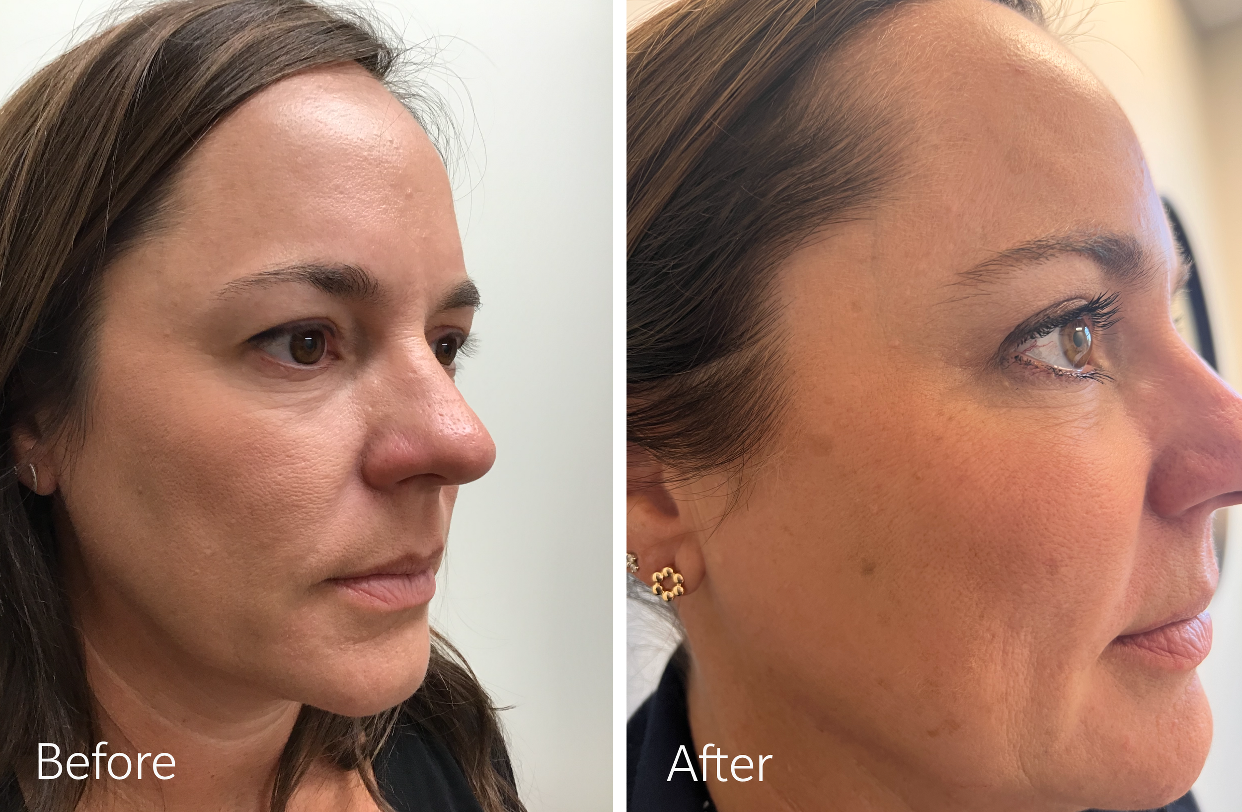 Eyelid surgery by Dr. Steven Porto, Board Certified Plastic Surgeon in Indianapolis, Indiana