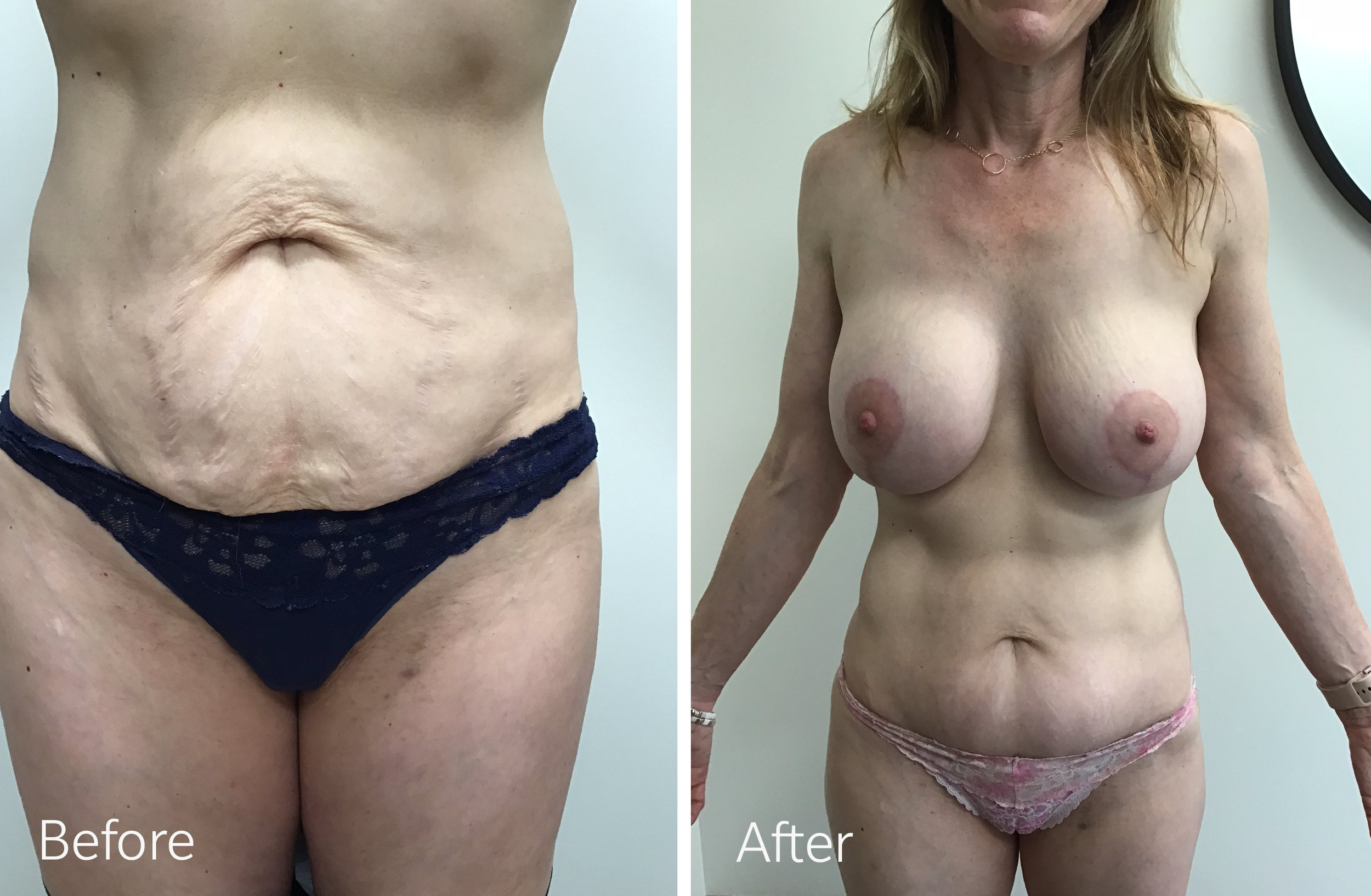Tummy tuck, breast lift and implant surgery by Dr. Steven Porto, Board Certified Plastic Surgeon in Indianapolis, Indiana