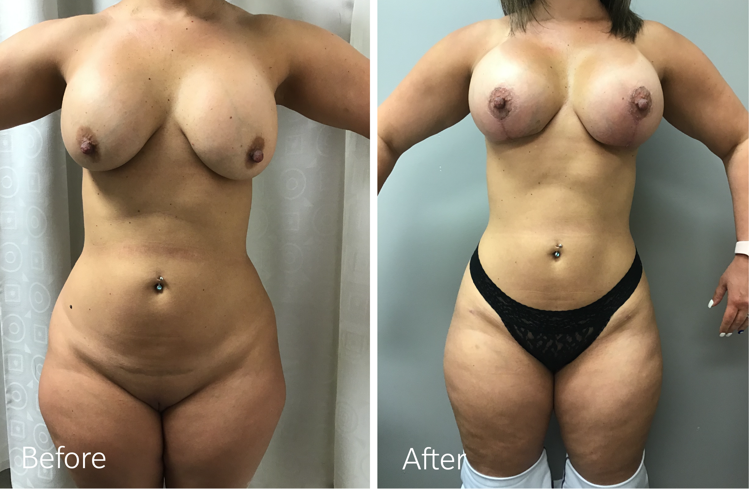 Tummy Tuck and Liposuction by Dr. Steven Porto, Board Certified Plastic Surgeon in Indianapolis, Indiana