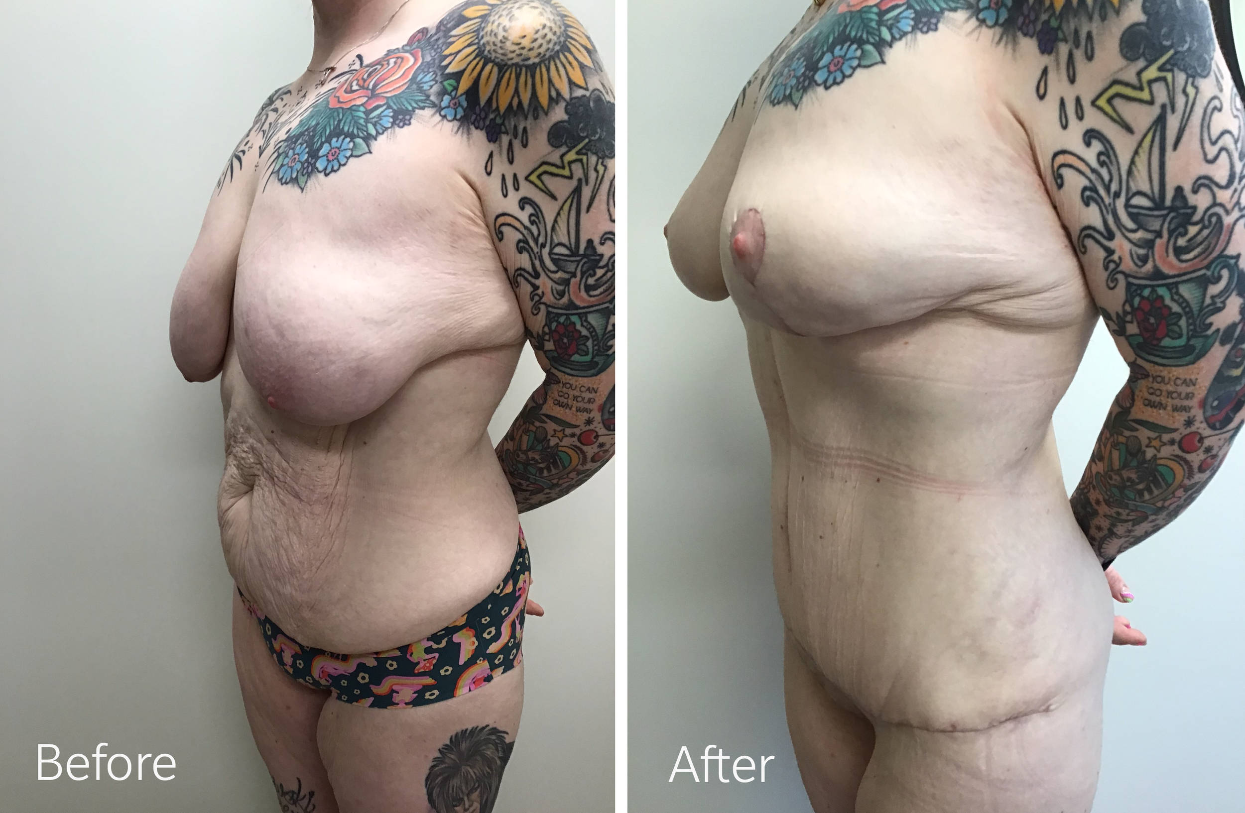 Tummy tuck, breast lift and implant surgery by Dr. Steven Porto, Board Certified Plastic Surgeon in Indianapolis, Indiana
