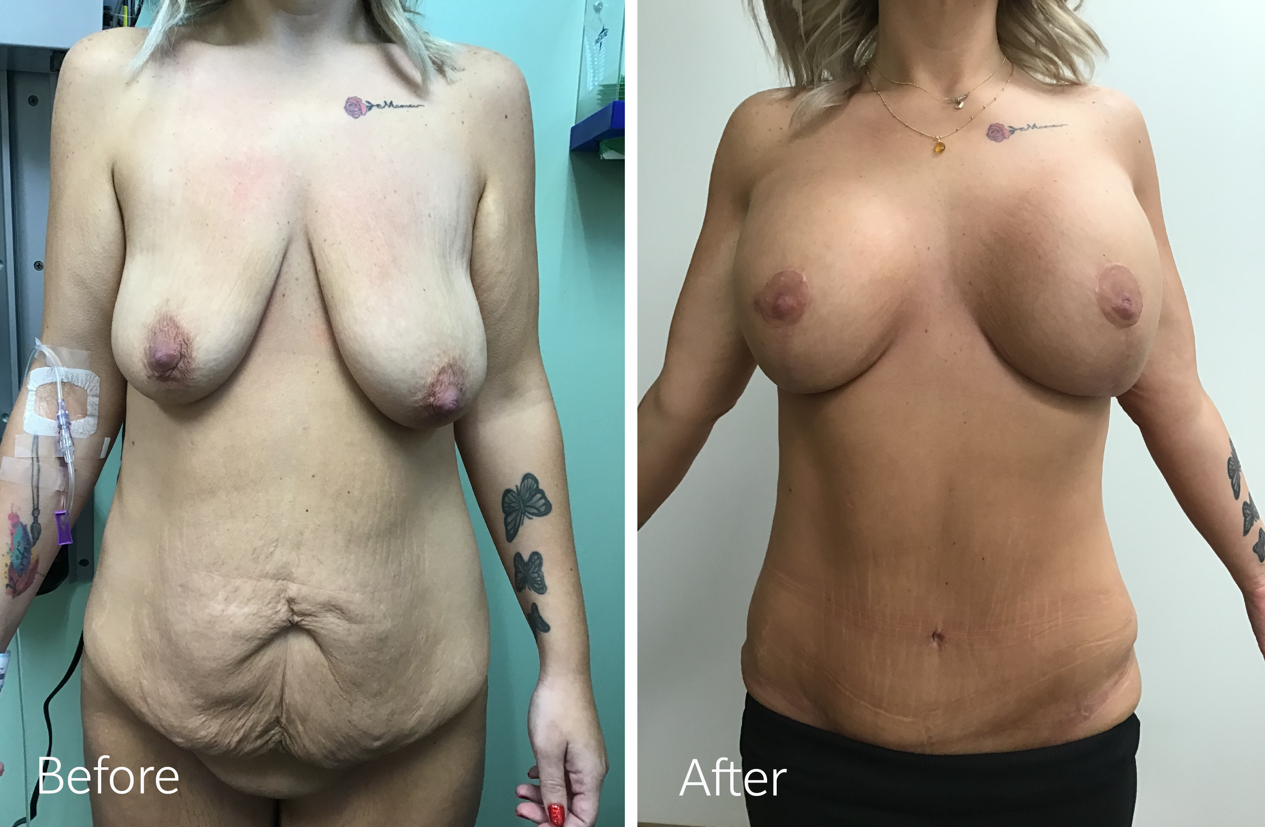 Mommy Makeover Tummy Tuck, Liposuction, Breast Lift and Implants by Dr. Steven Porto, Board Certified Plastic Surgeon in Indianapolis, Indiana