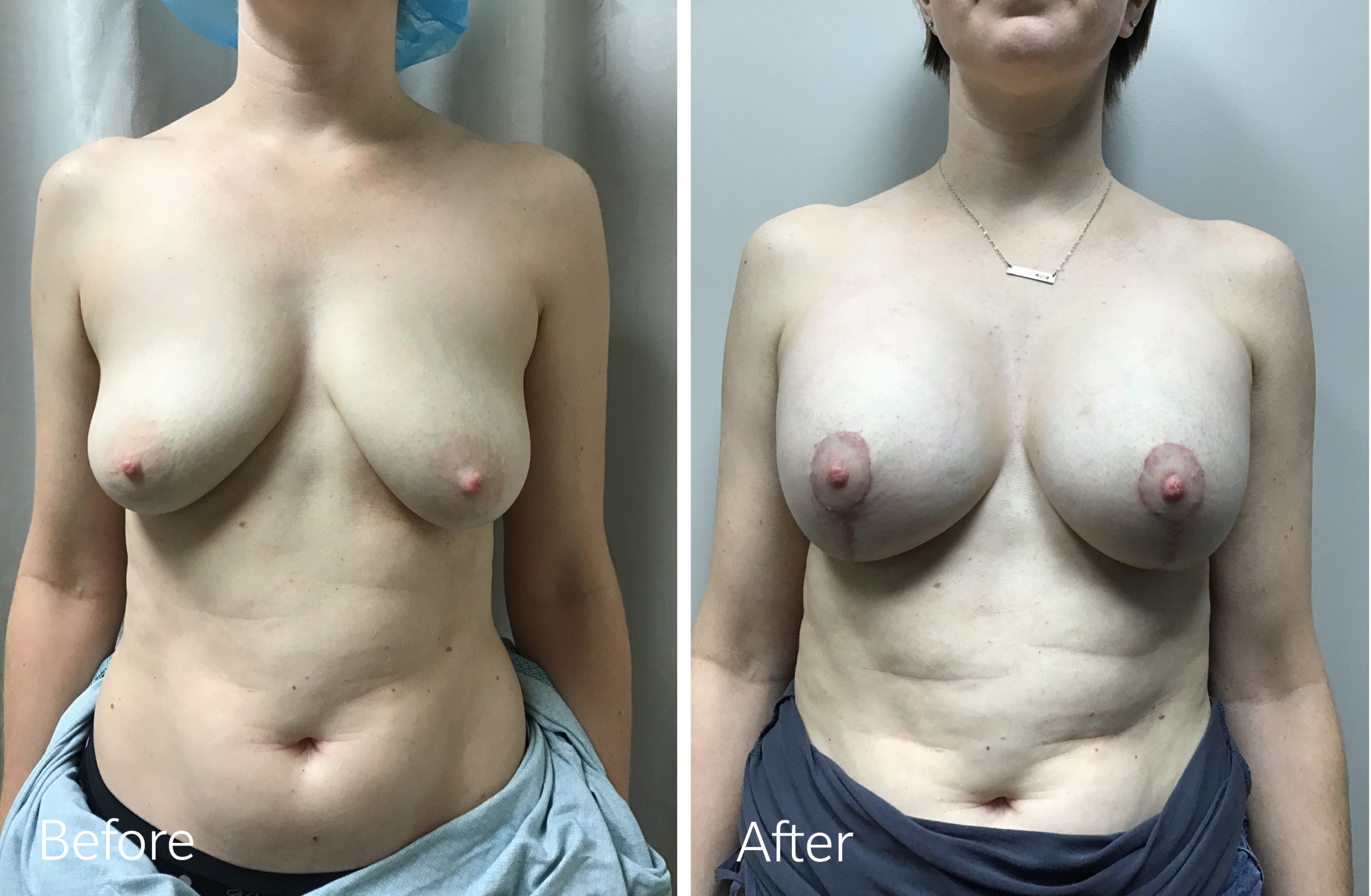Breast lift and augmentation surgery by Dr. Steven Porto