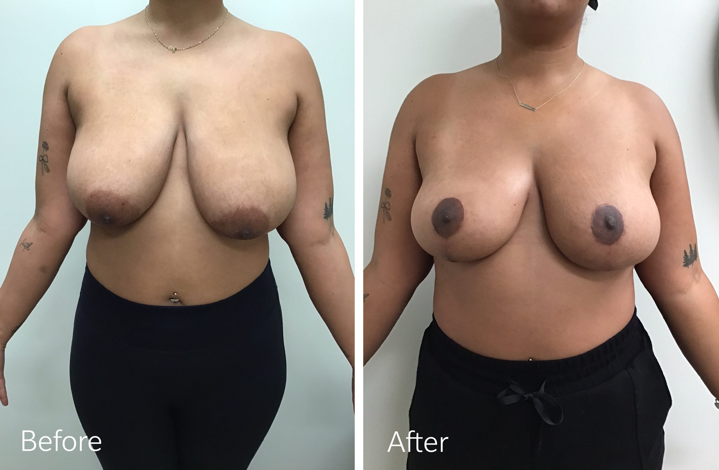 Dr Steven Porto Indianapolis Plastic Surgeon Breast Lift