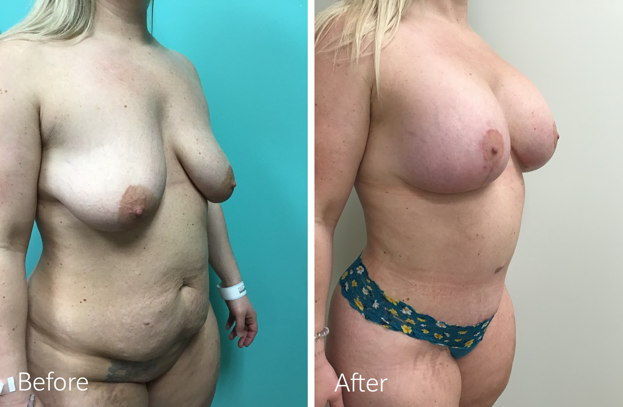 Tummy tuck, liposuction, breast lift and implant surgery by Dr. Steven Porto, Board Certified Plastic Surgeon in Indianapolis, Indiana