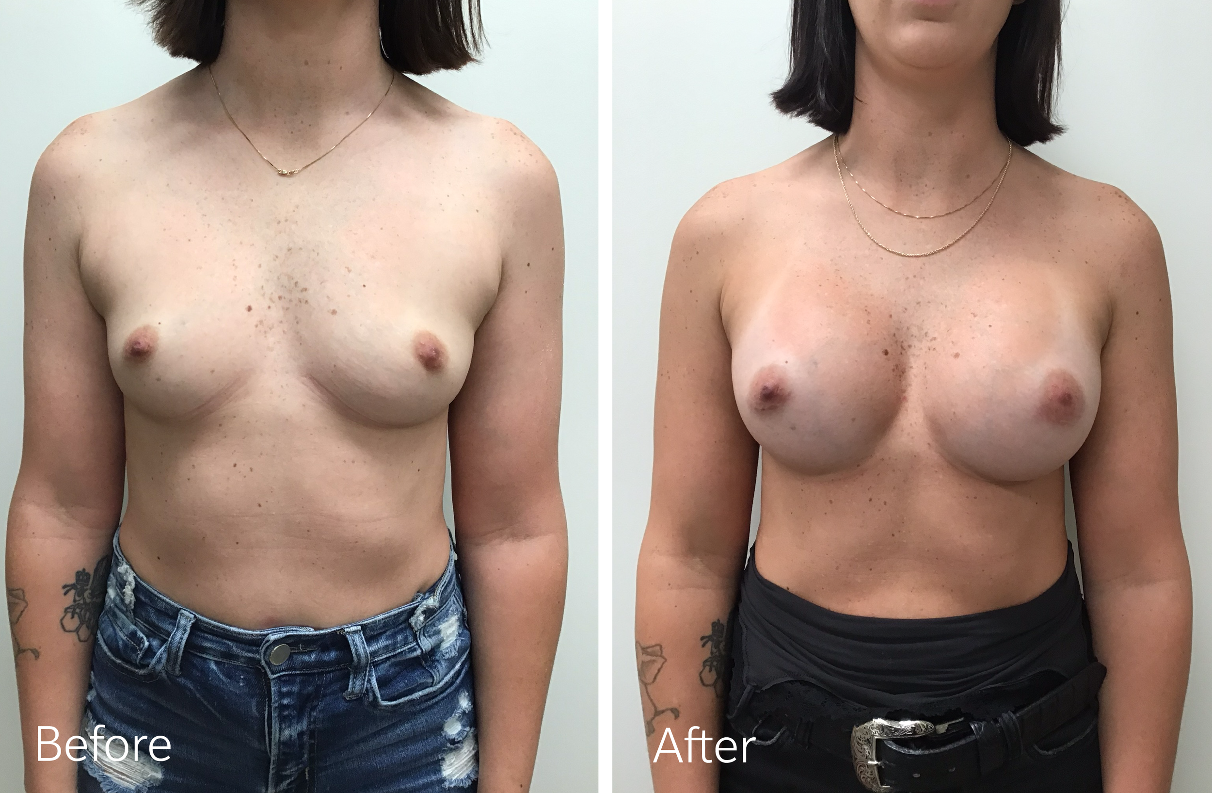 Breast Augmentation Surgery with 350cc Implants by Dr. Steven Porto